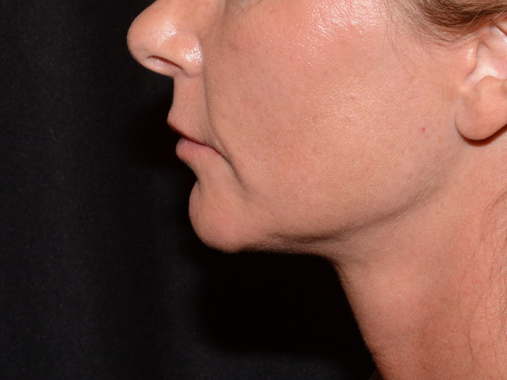 Before Image: Lip Filler - left-side