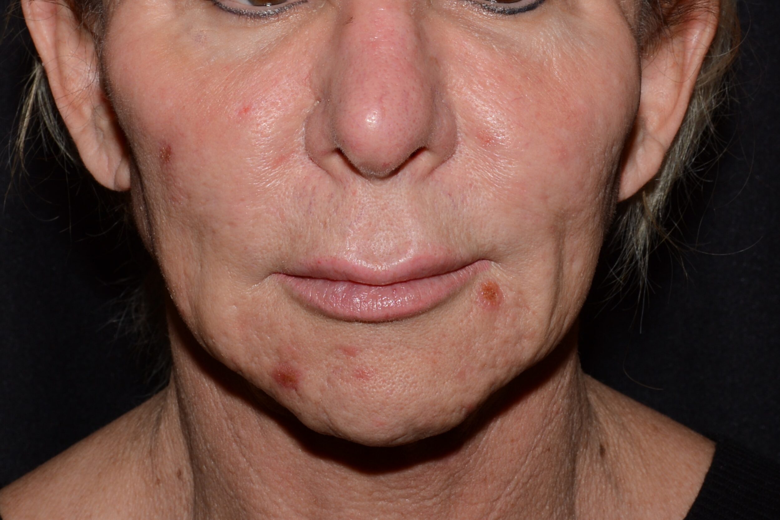 Before Image: Lip Lift/Flap - front