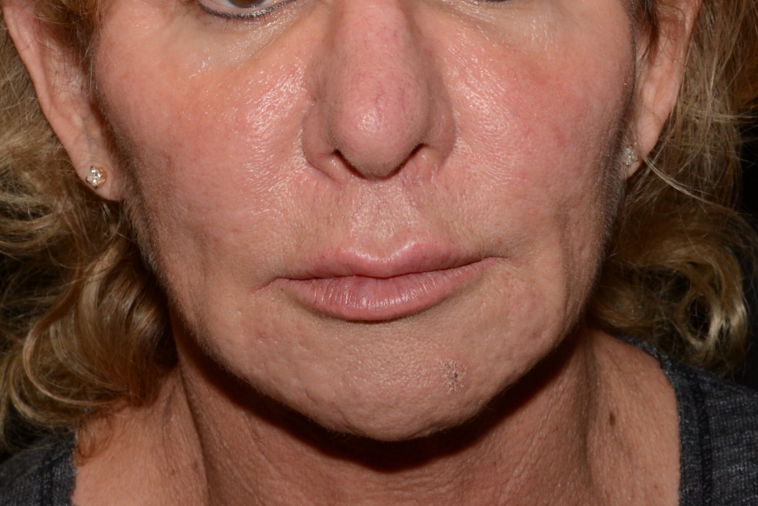 After Image: Lip Lift/Flap - front