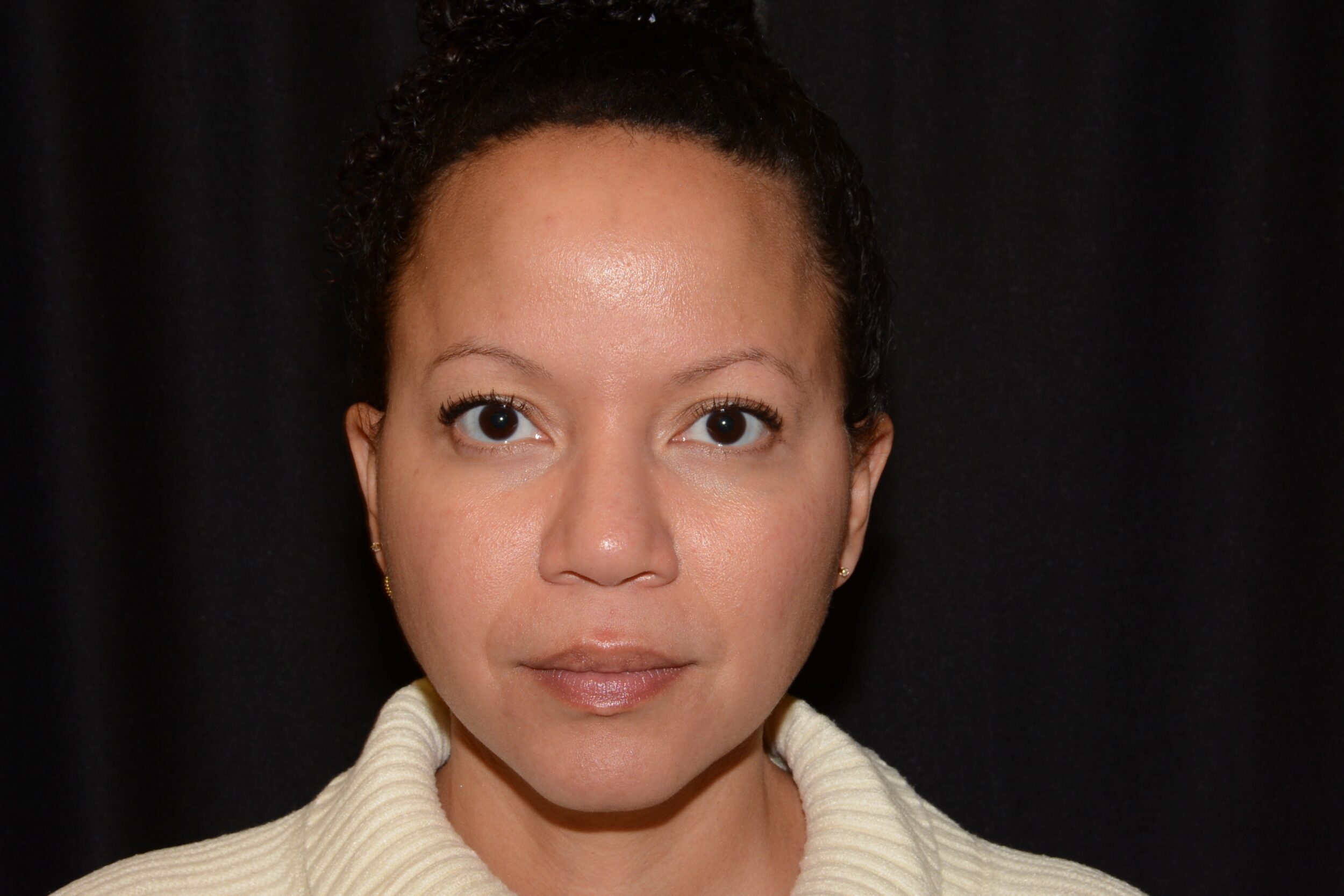 After Image: Eleven’s Brow Lift - front