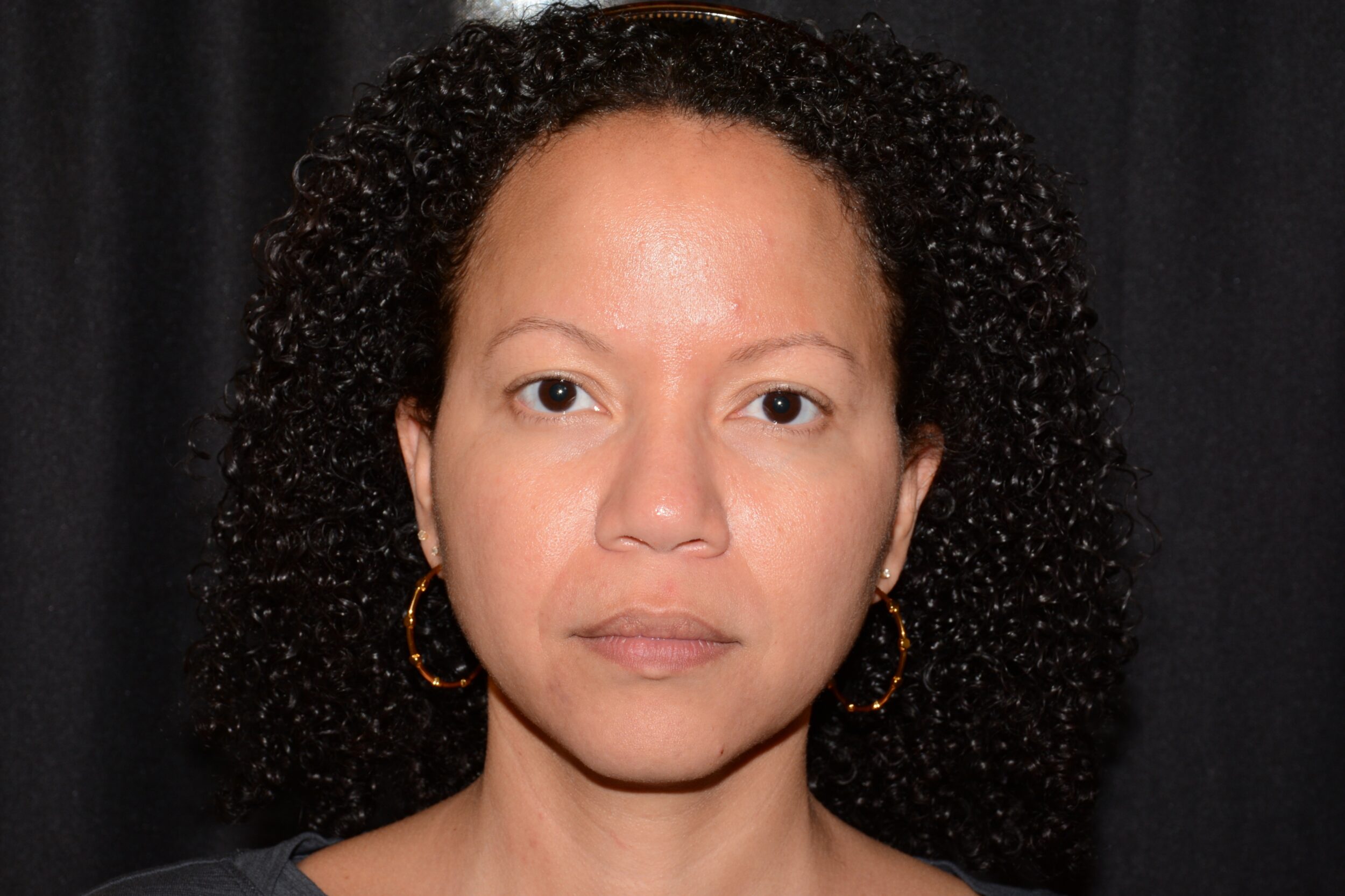 Before Image: Eleven’s Brow Lift - front