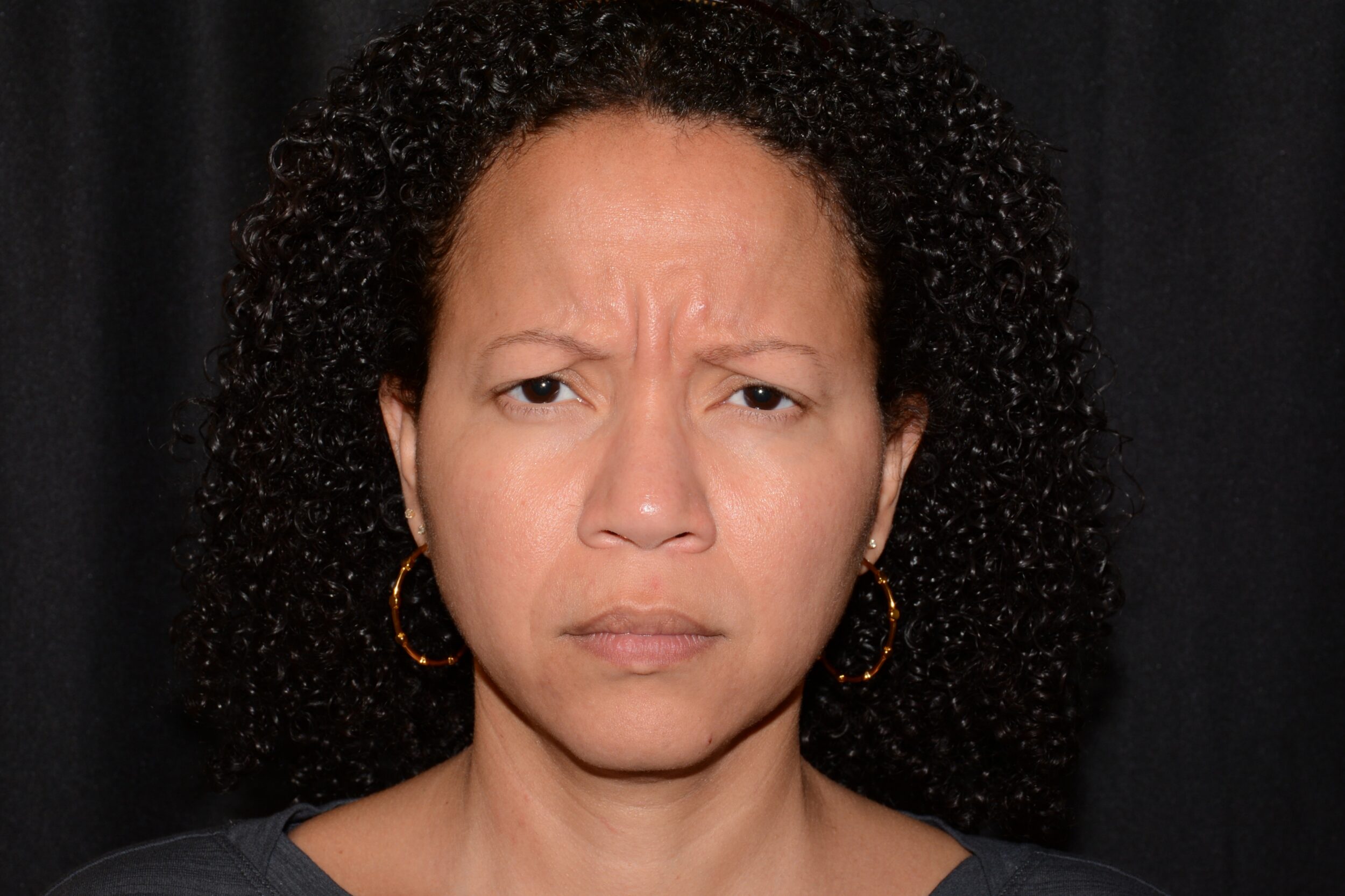 Before Image: Eleven’s Brow Lift - front