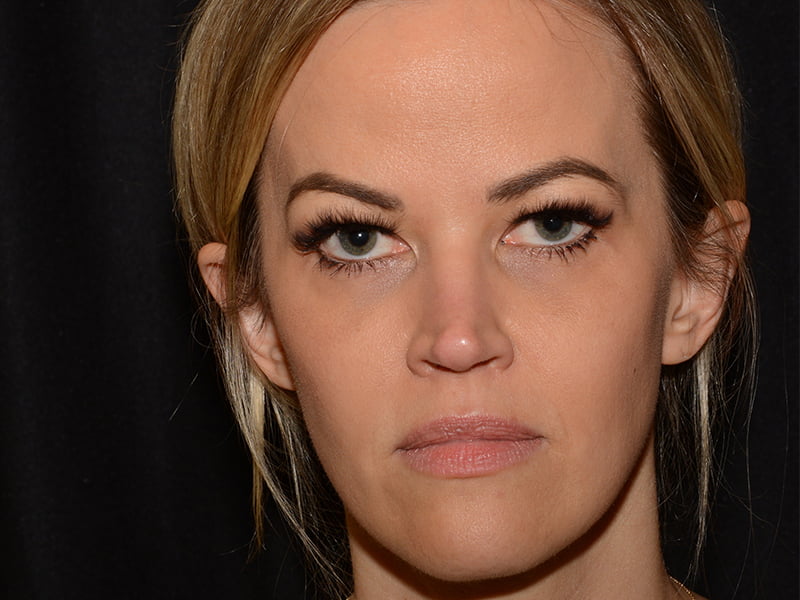 After Image: Morpheus8 - front