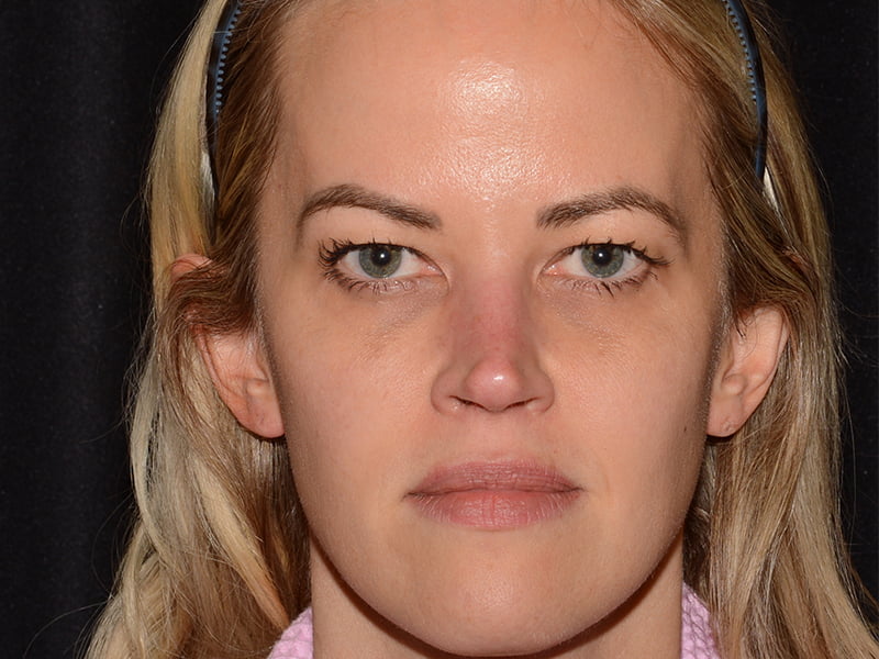 Before Image: Morpheus8 - front