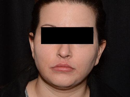 After Image: Morpheus8 - front