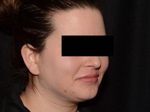 After Image: Morpheus8 - right-front-oblique