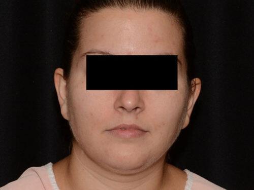 Before Image: Morpheus8 - front