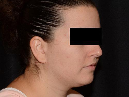 Before Image: Morpheus8 - right-front-oblique