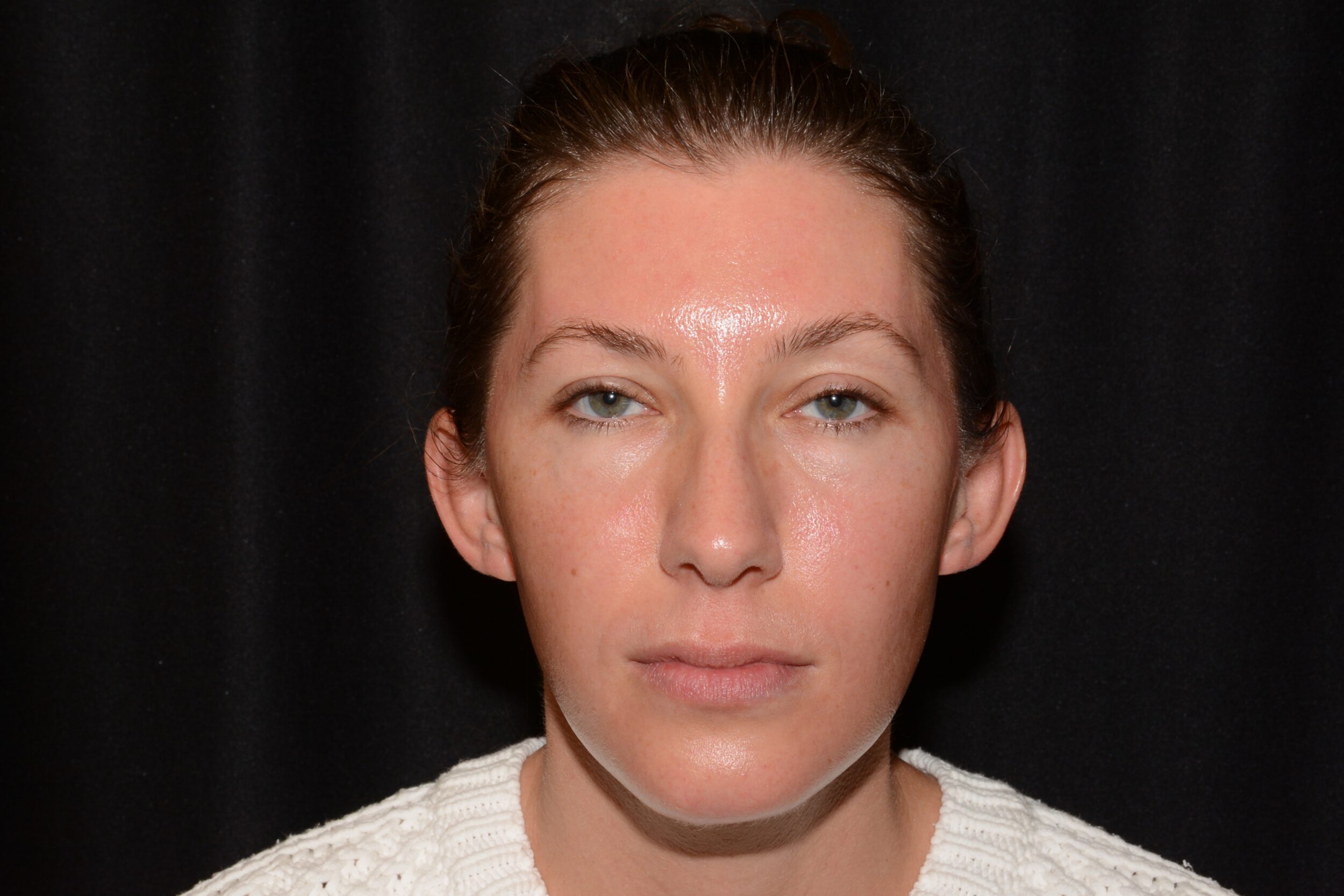 Before Image: Upper Face - front