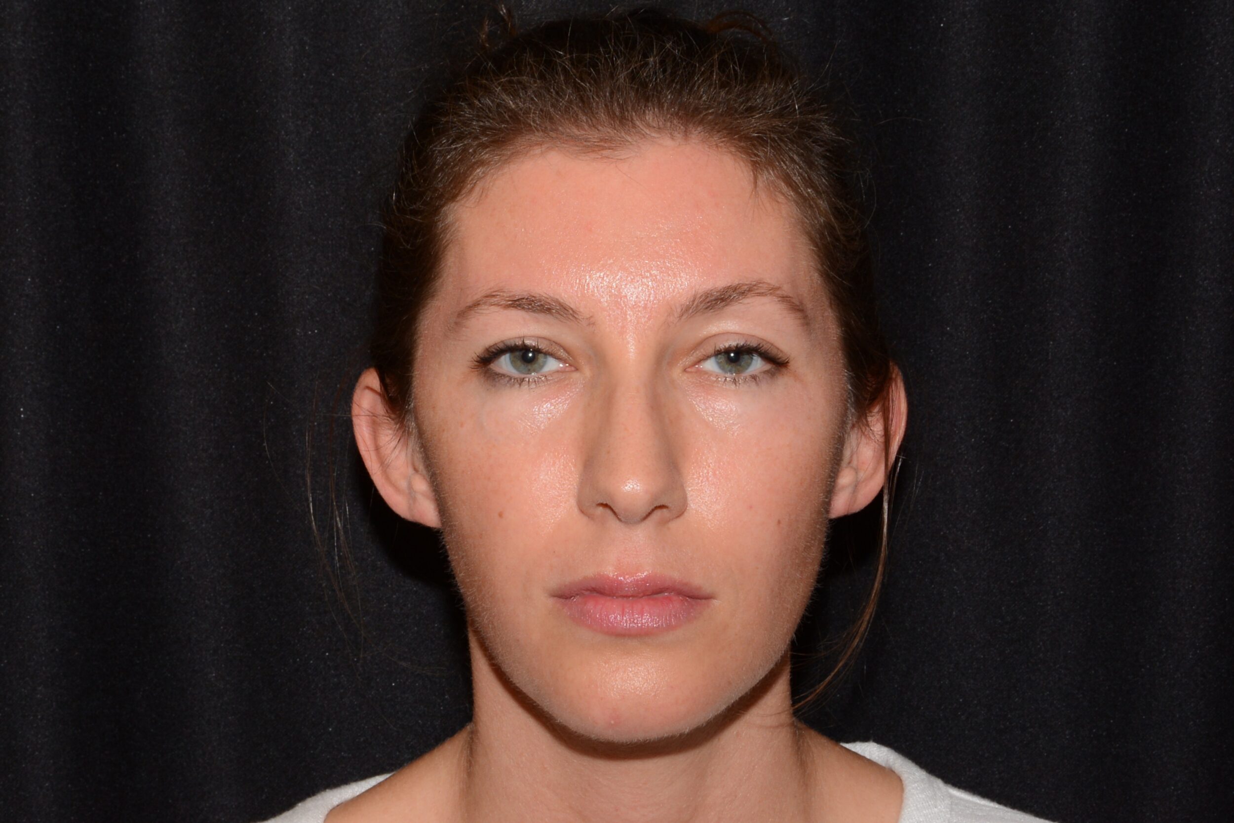 After Image: Upper Face - front