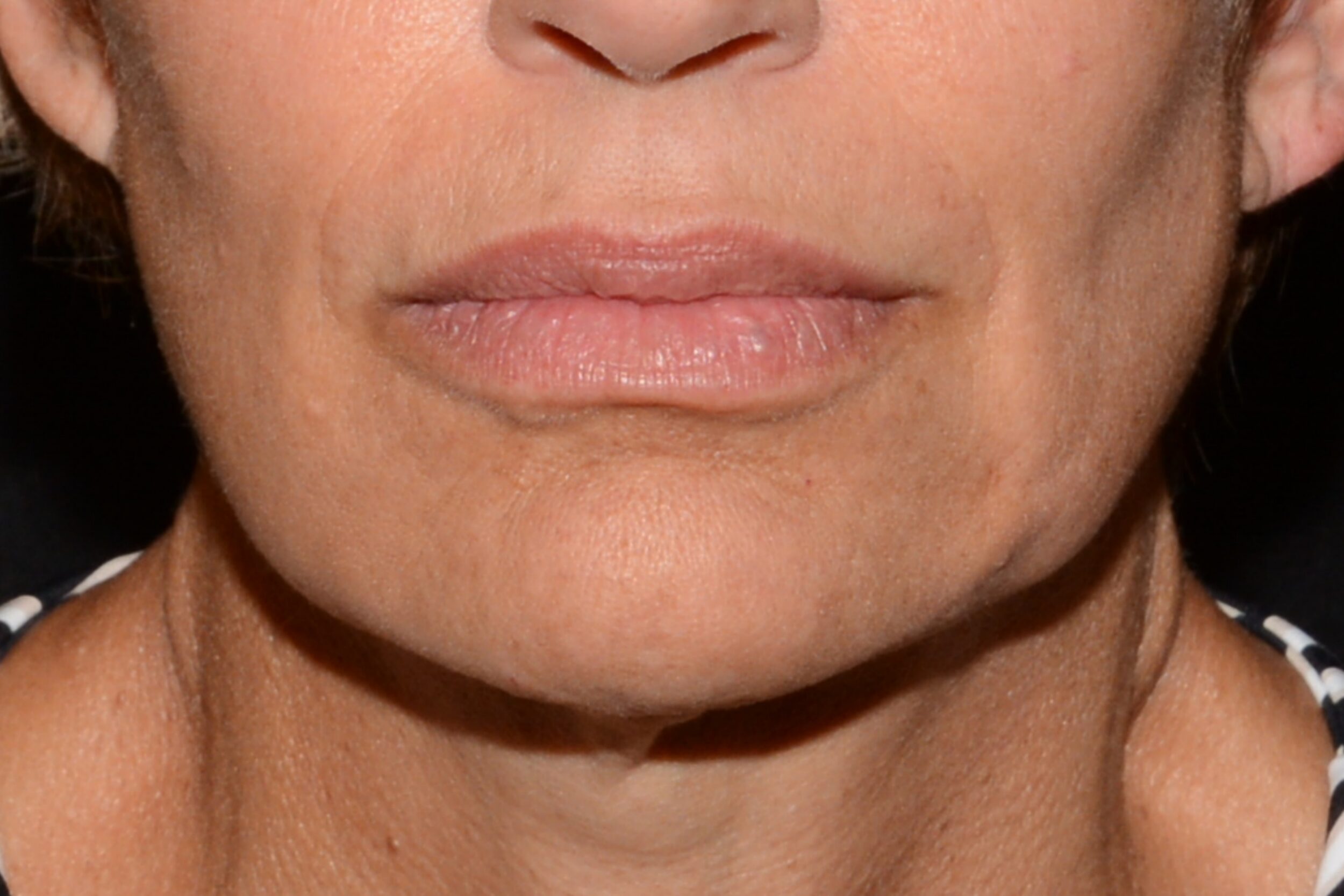 After Image: Sad Smile Correction - front