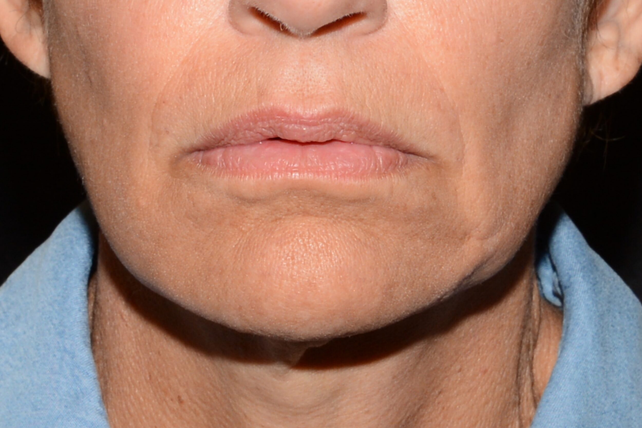 Before Image: Sad Smile Correction - front