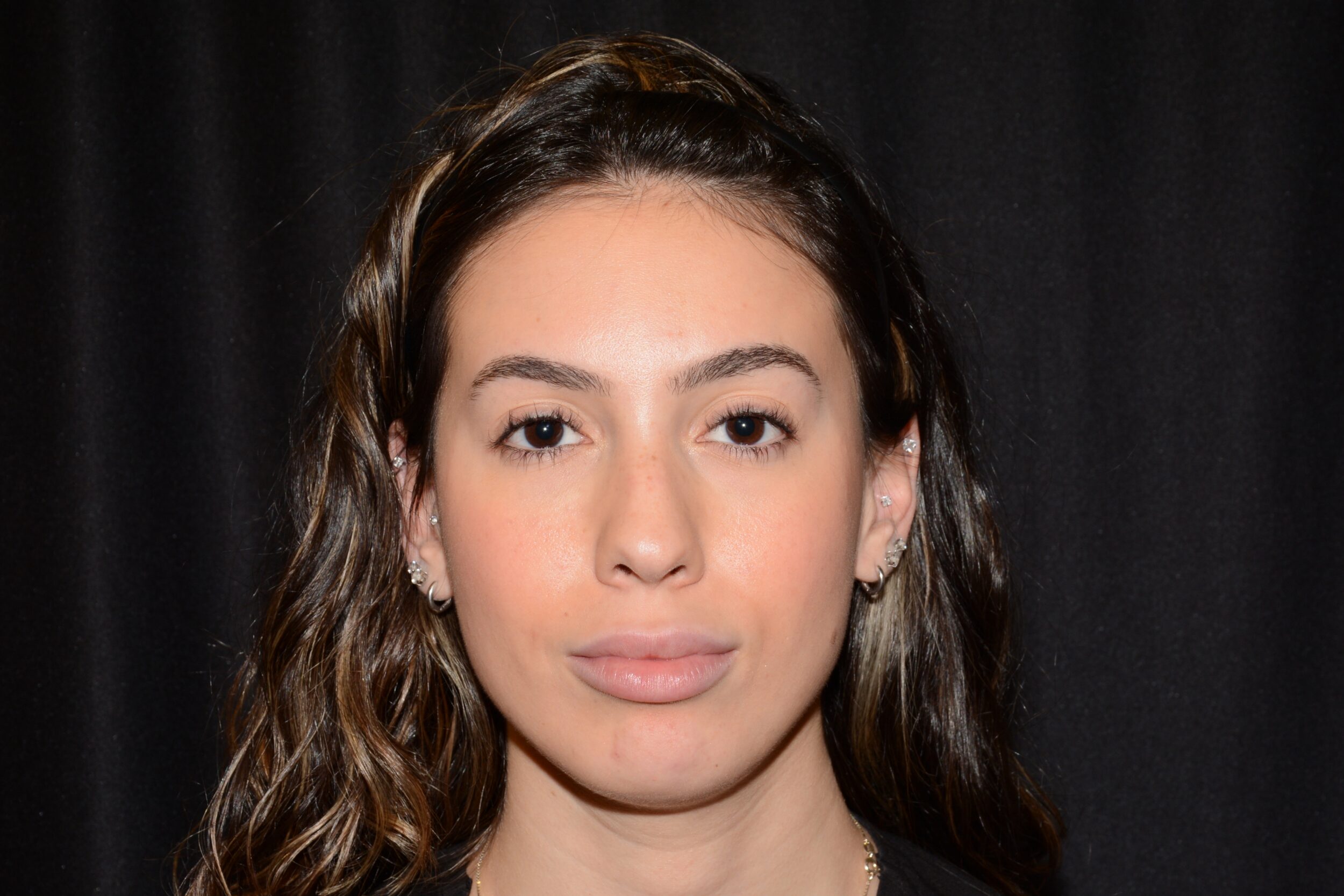 Before Image: Jaw Slimming - front