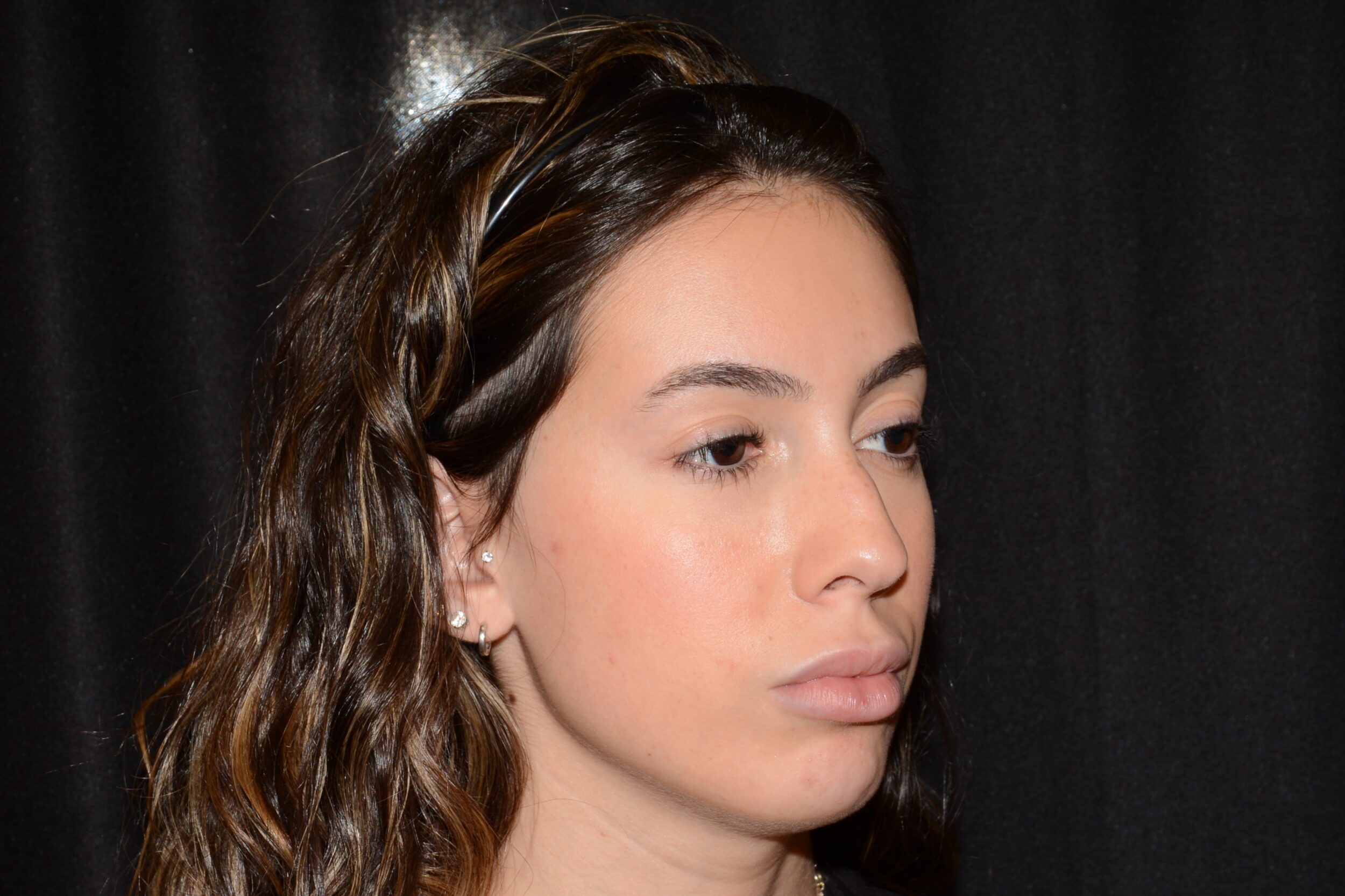 Before Image: Jaw Slimming - right-front-oblique