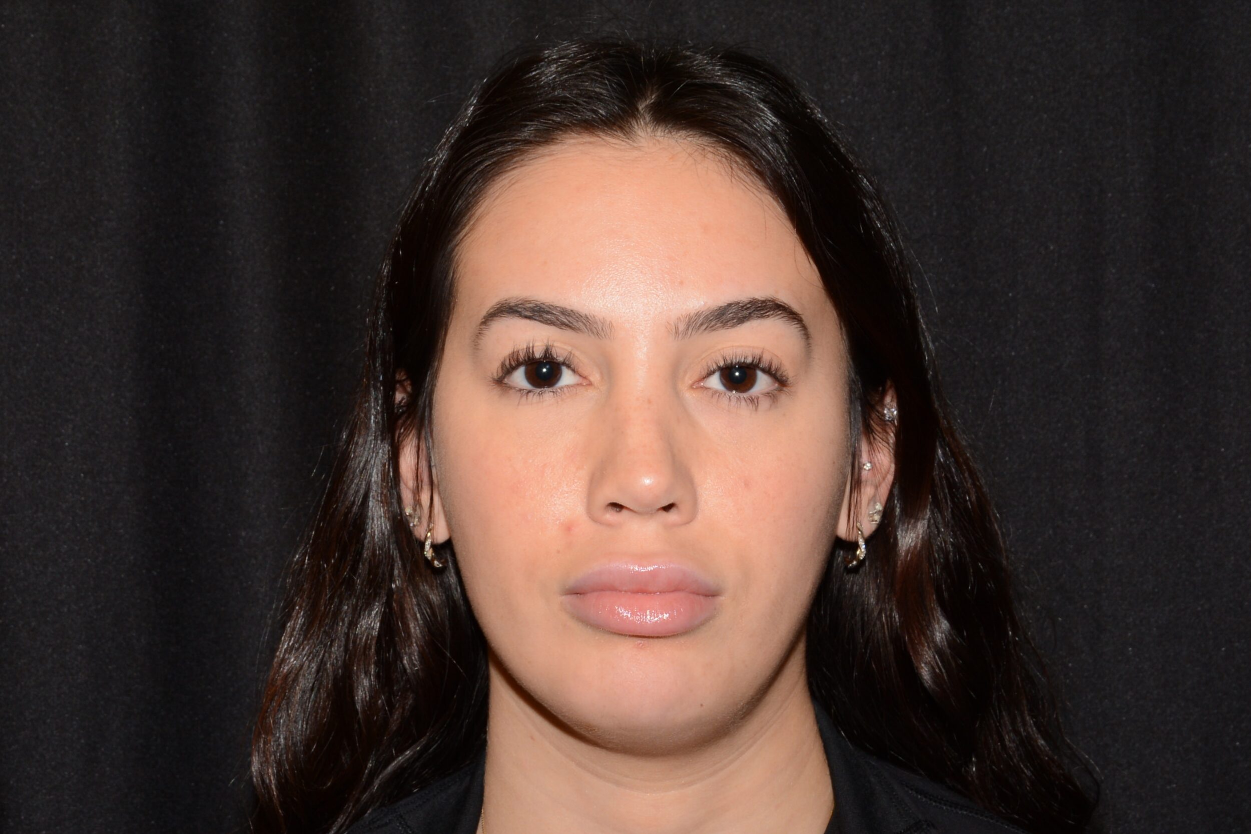 After Image: Jaw Slimming - front