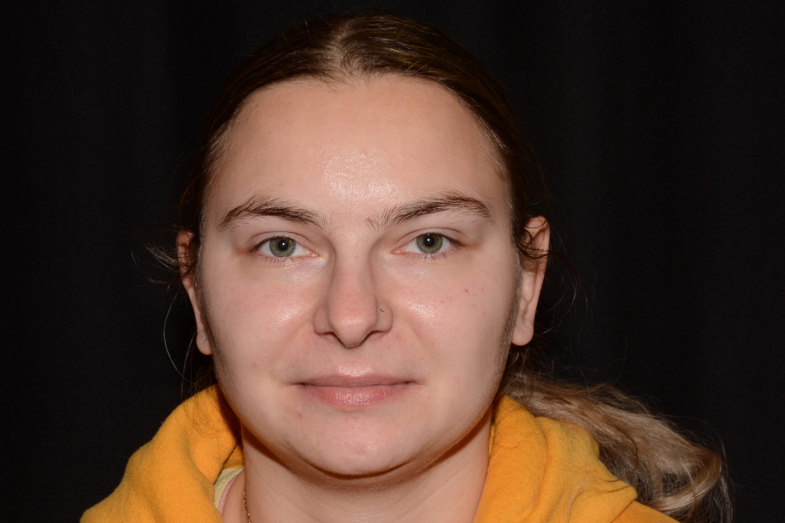 After Image: Upper Face - front