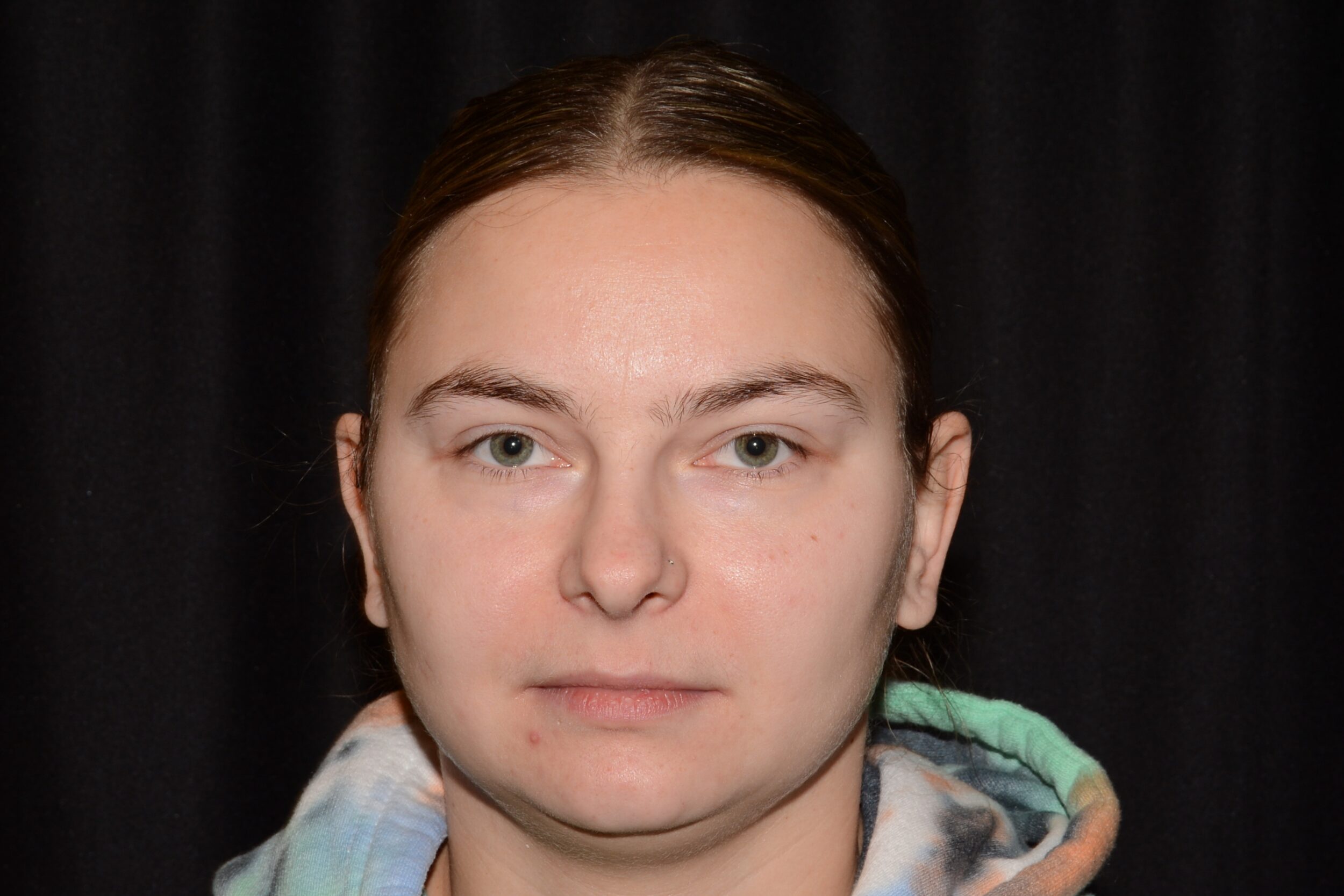 Before Image: Upper Face - front