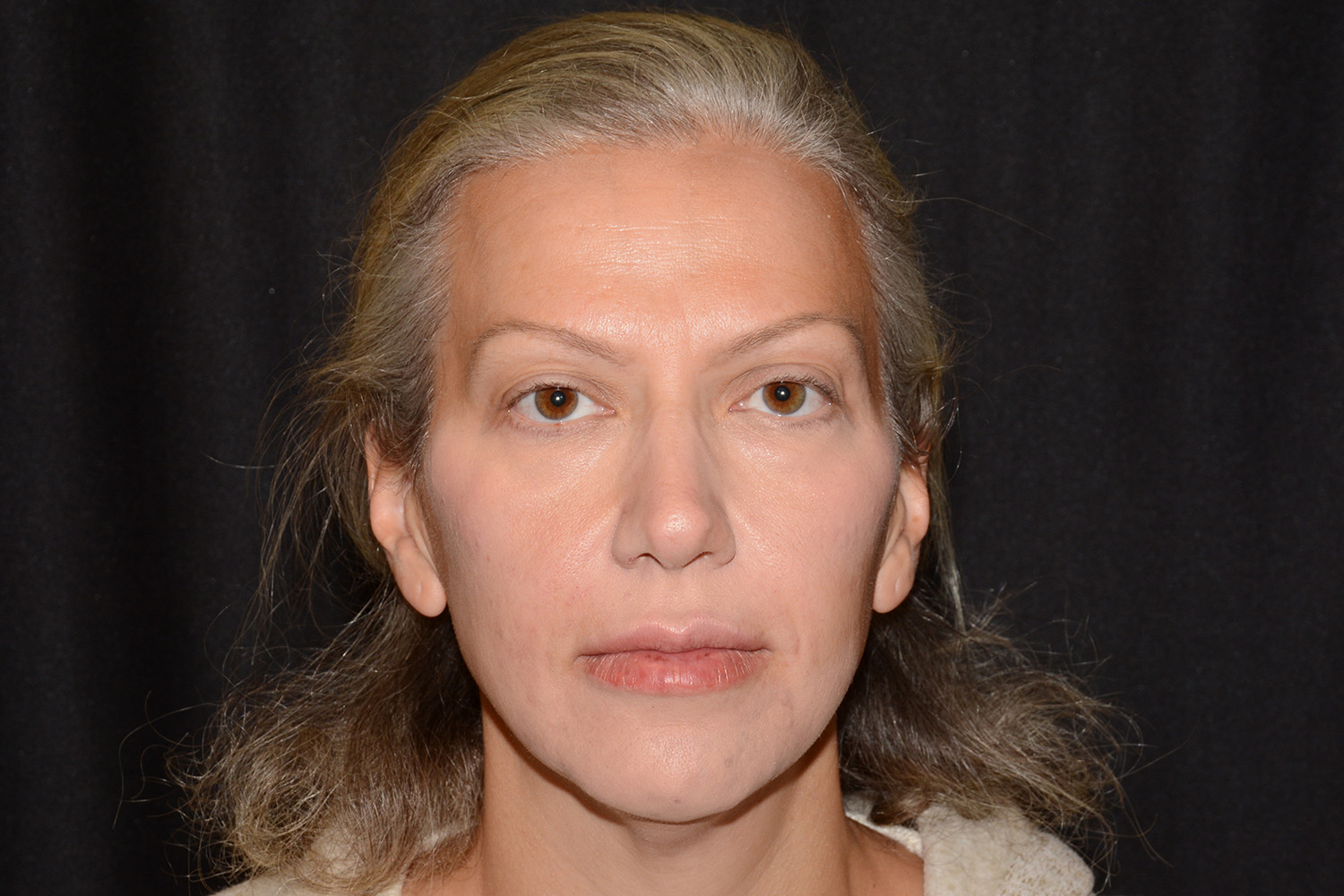After Image: Facial Balance - front