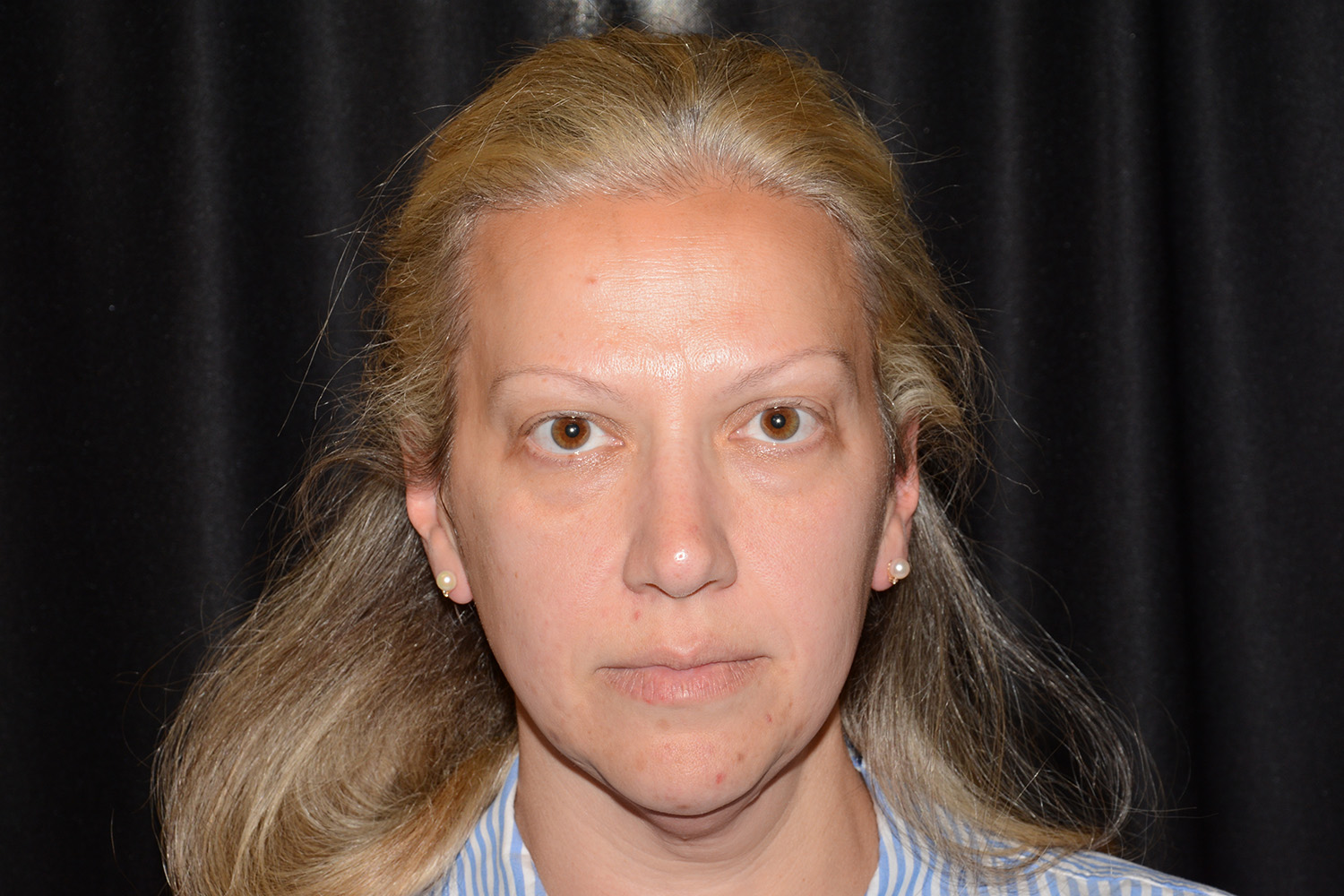 Before Image: Facial Balance - front