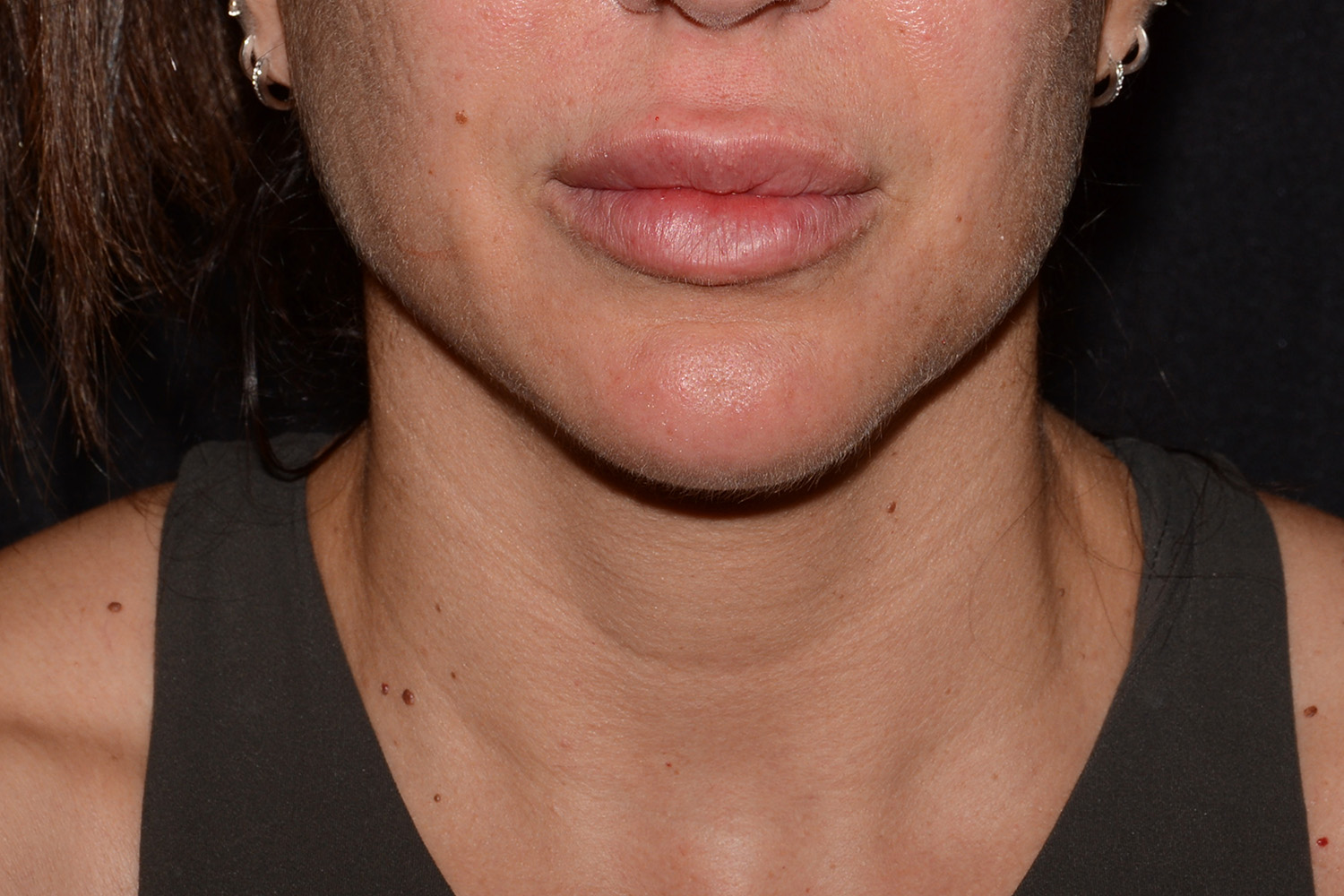 After Image: Lip Filler - front