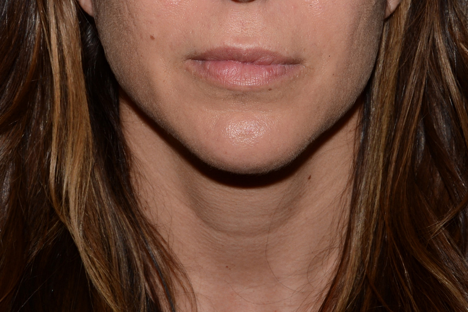 Before Image: Lip Filler - front