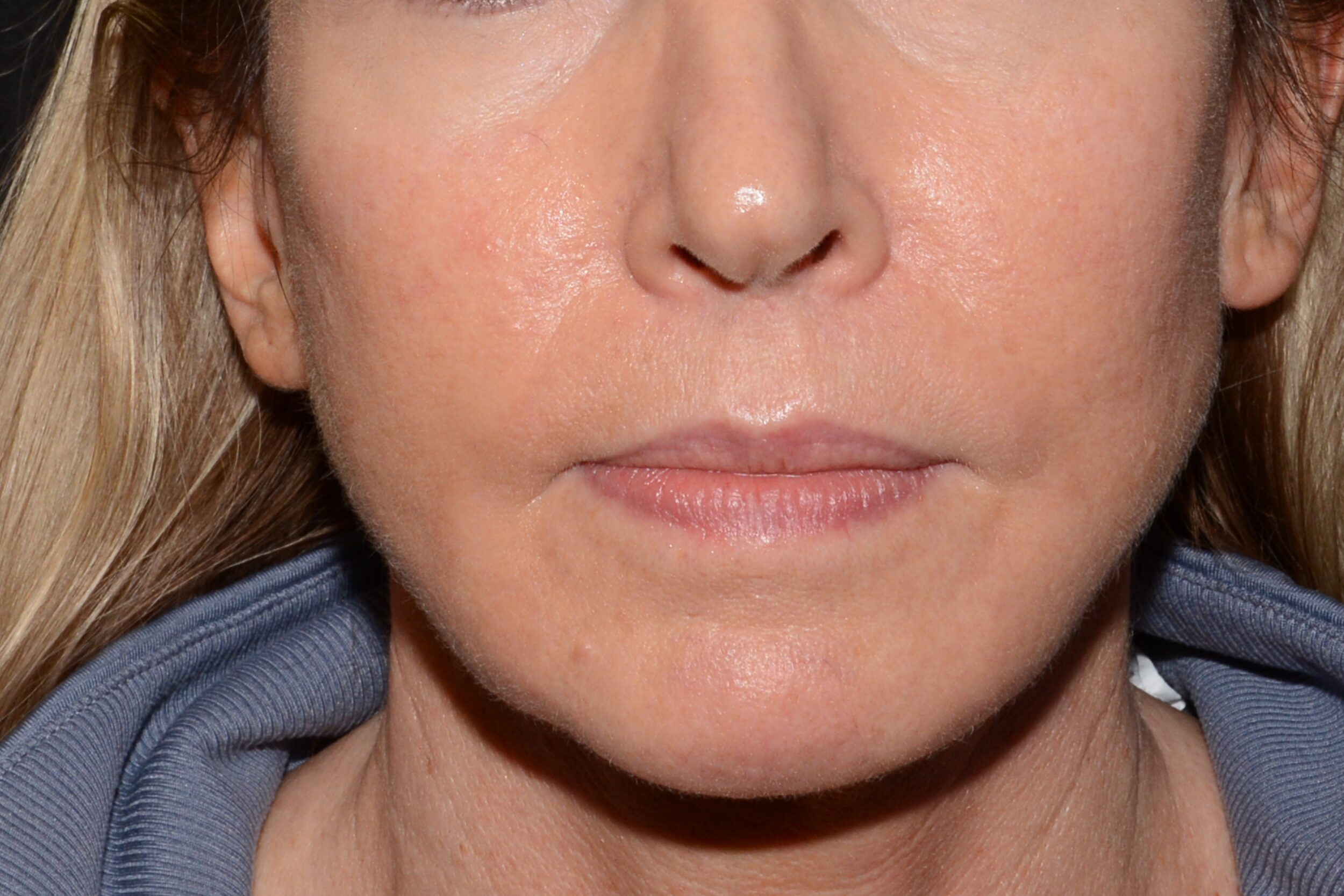 After Image: Lip Lift/Flap - front