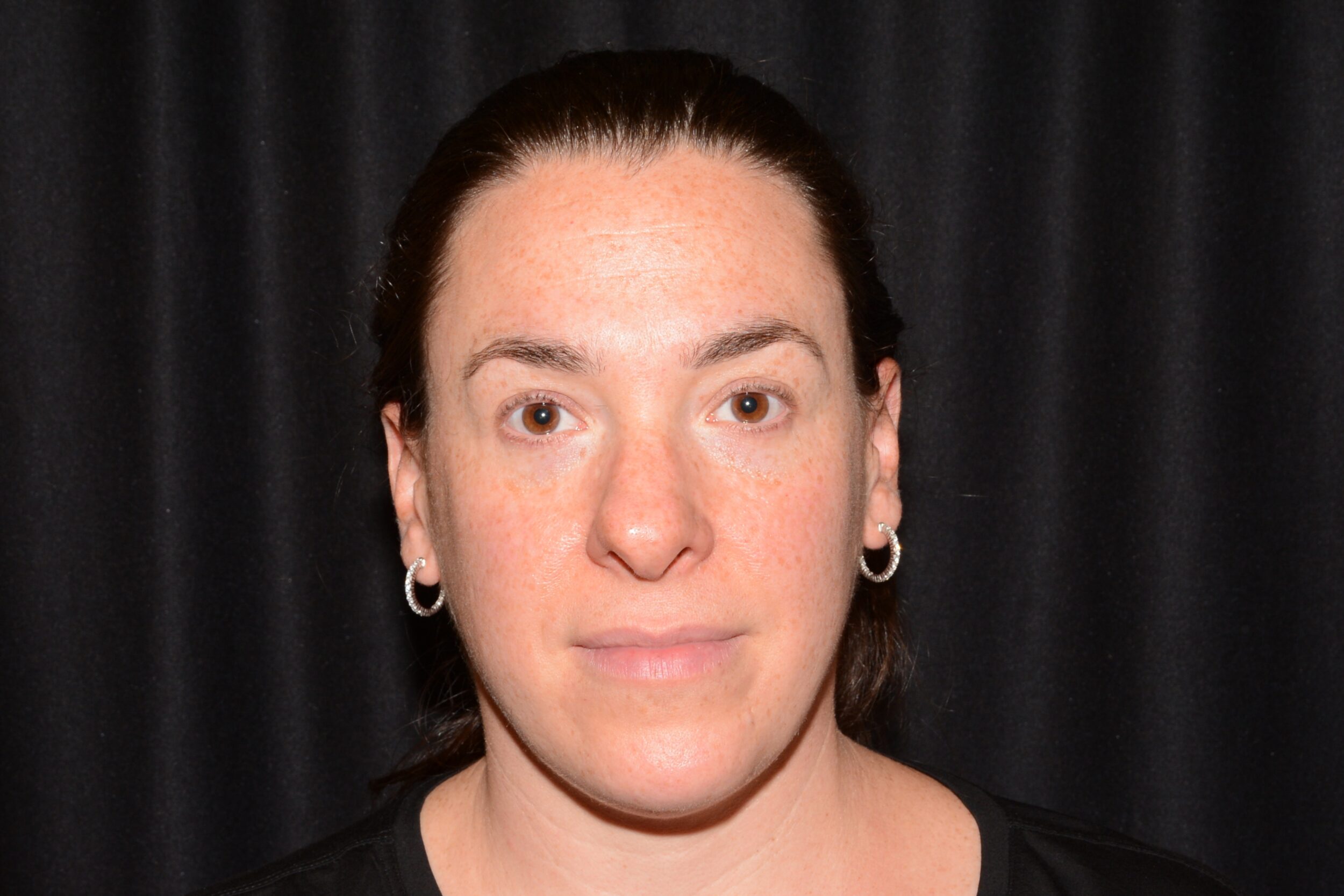 Before Image: Eleven’s Brow Lift - front