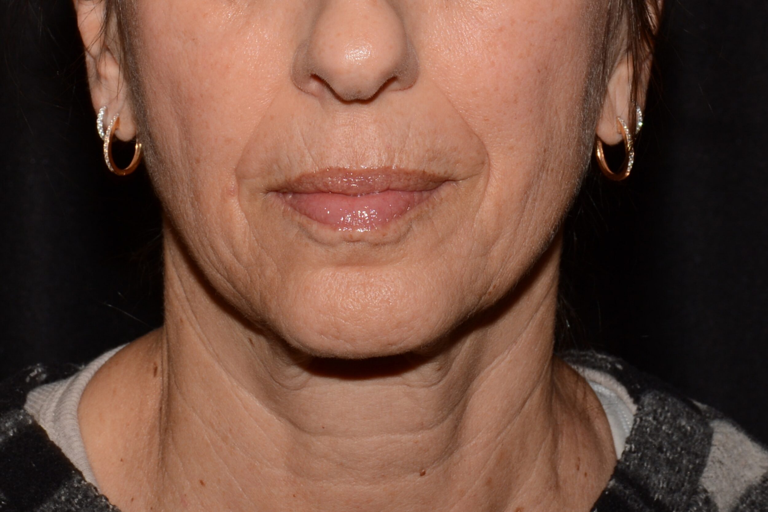 After Image: Chin Smoothing - front