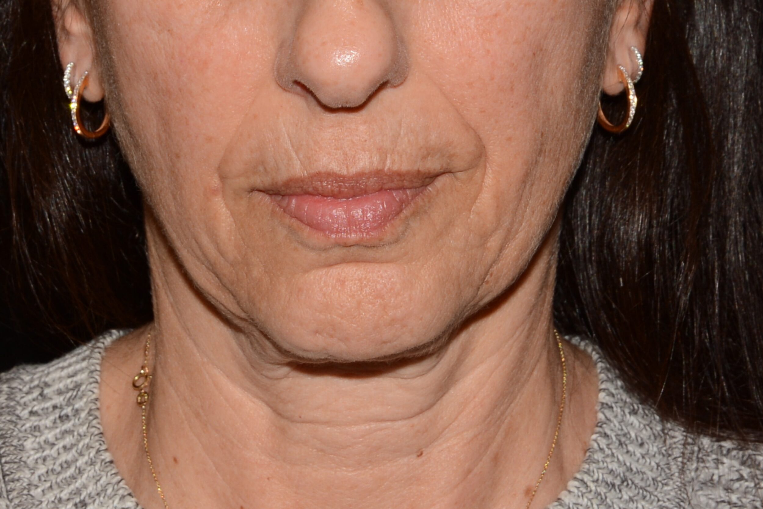 Before Image: Chin Smoothing - front