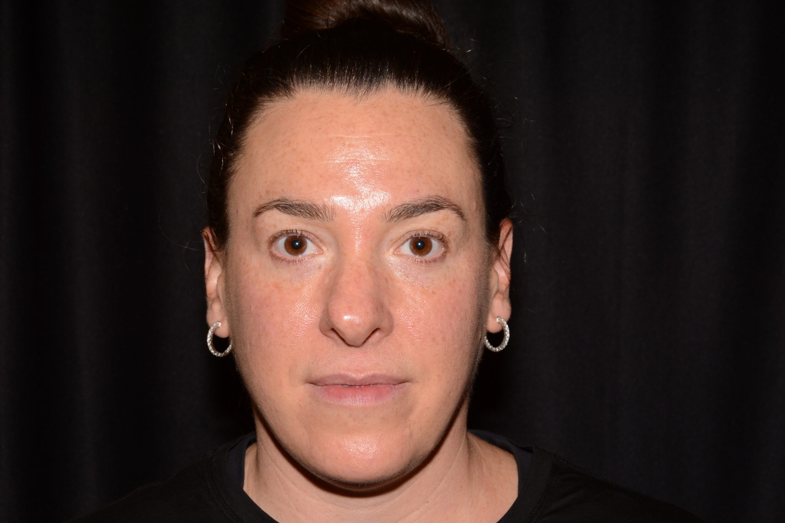 After Image: Eleven’s Brow Lift - front