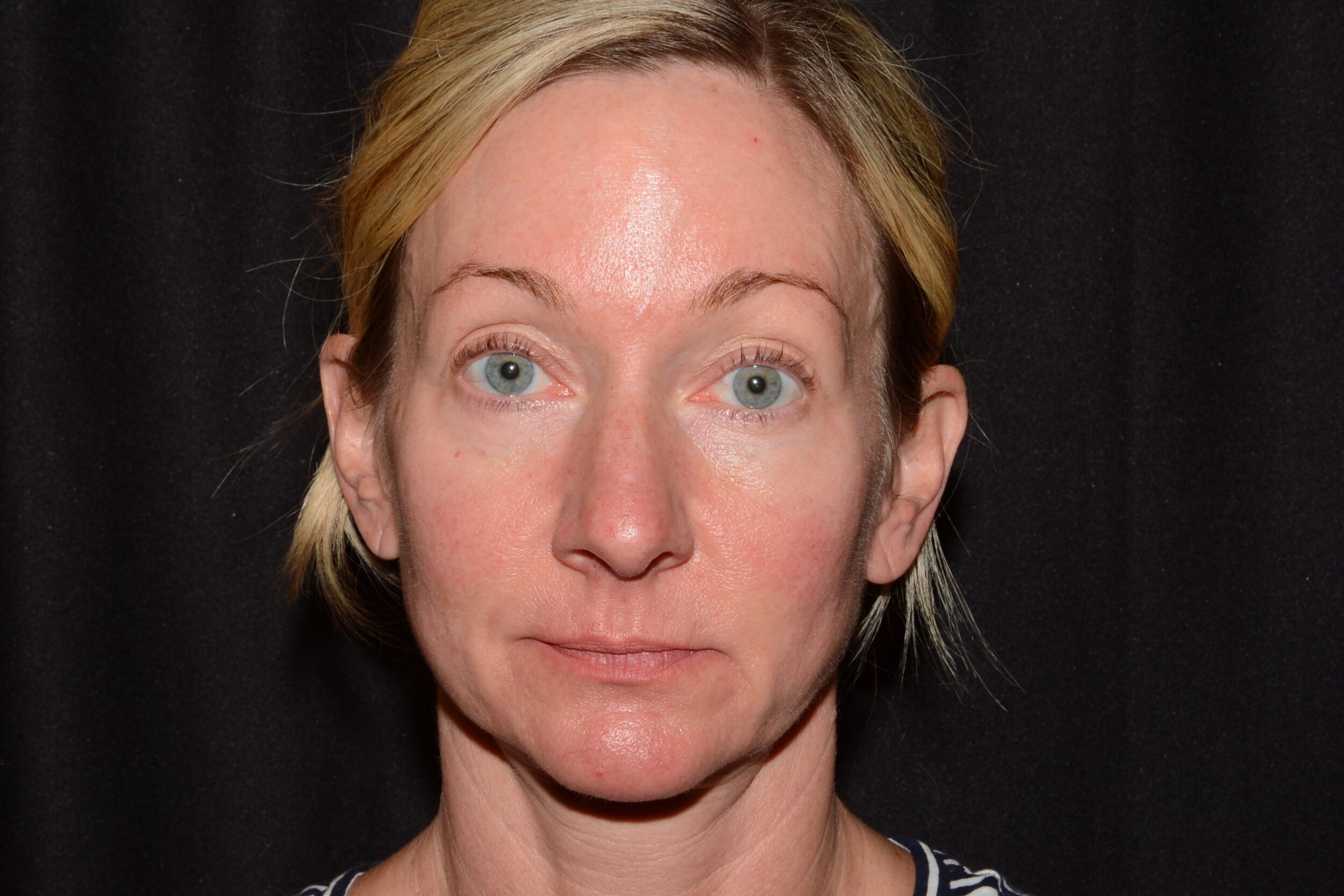 Before Image: Brow Lift - front