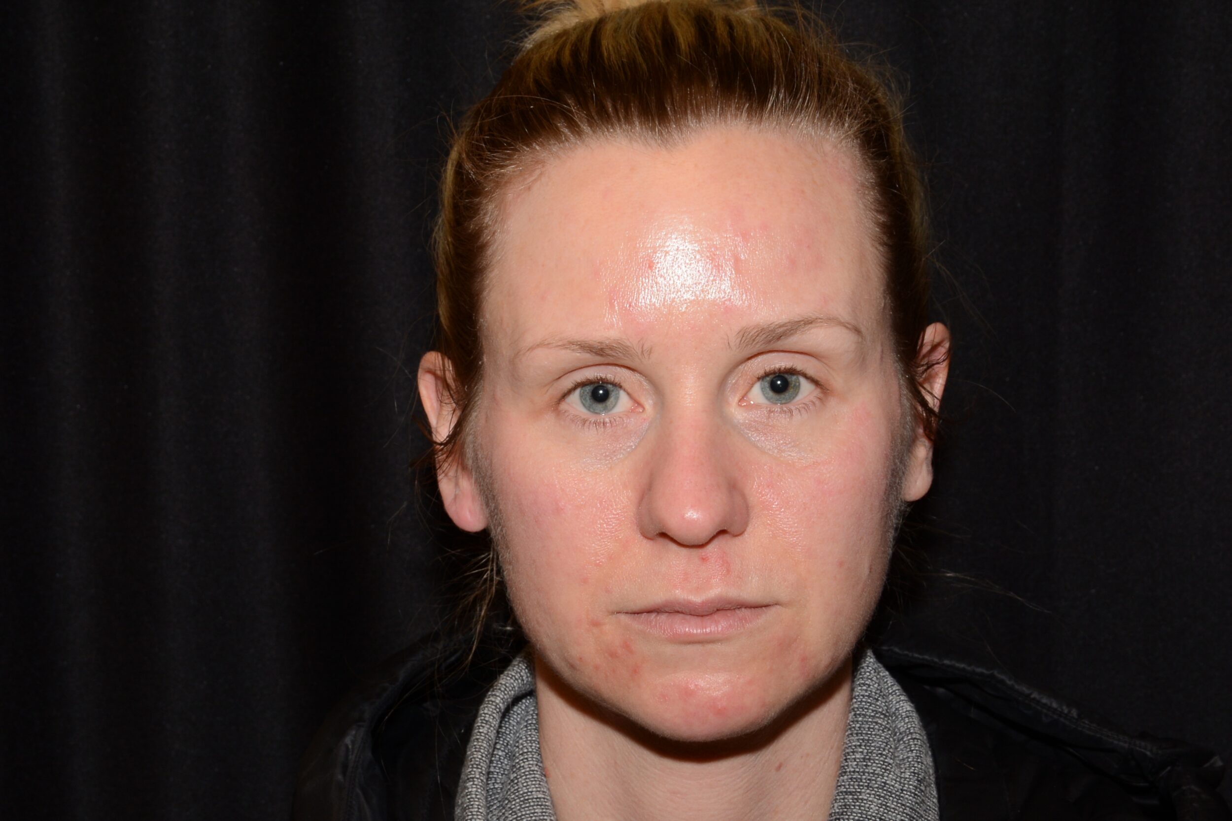 After Image: Eleven’s Brow Lift - front