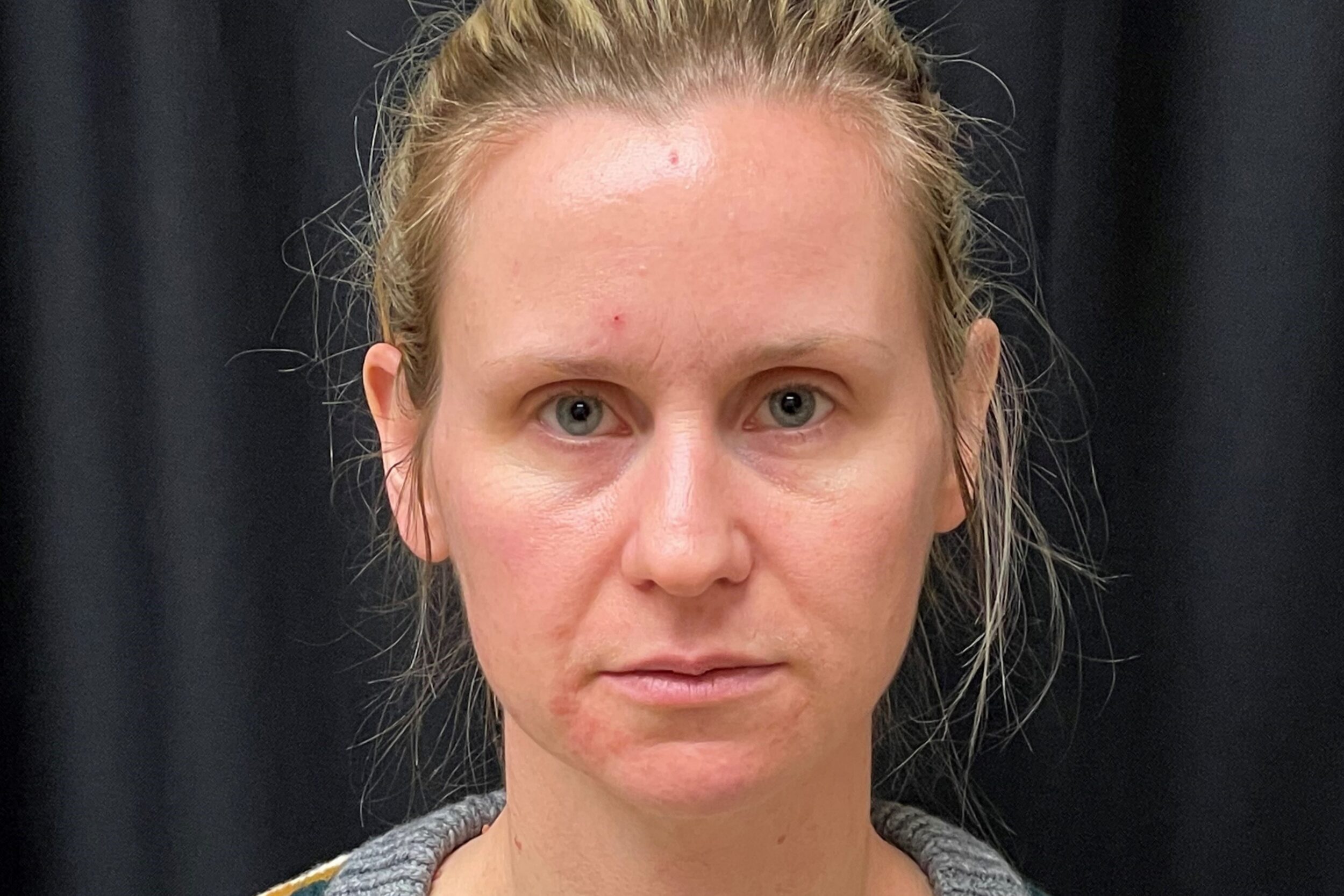 Before Image: Eleven’s Brow Lift - front