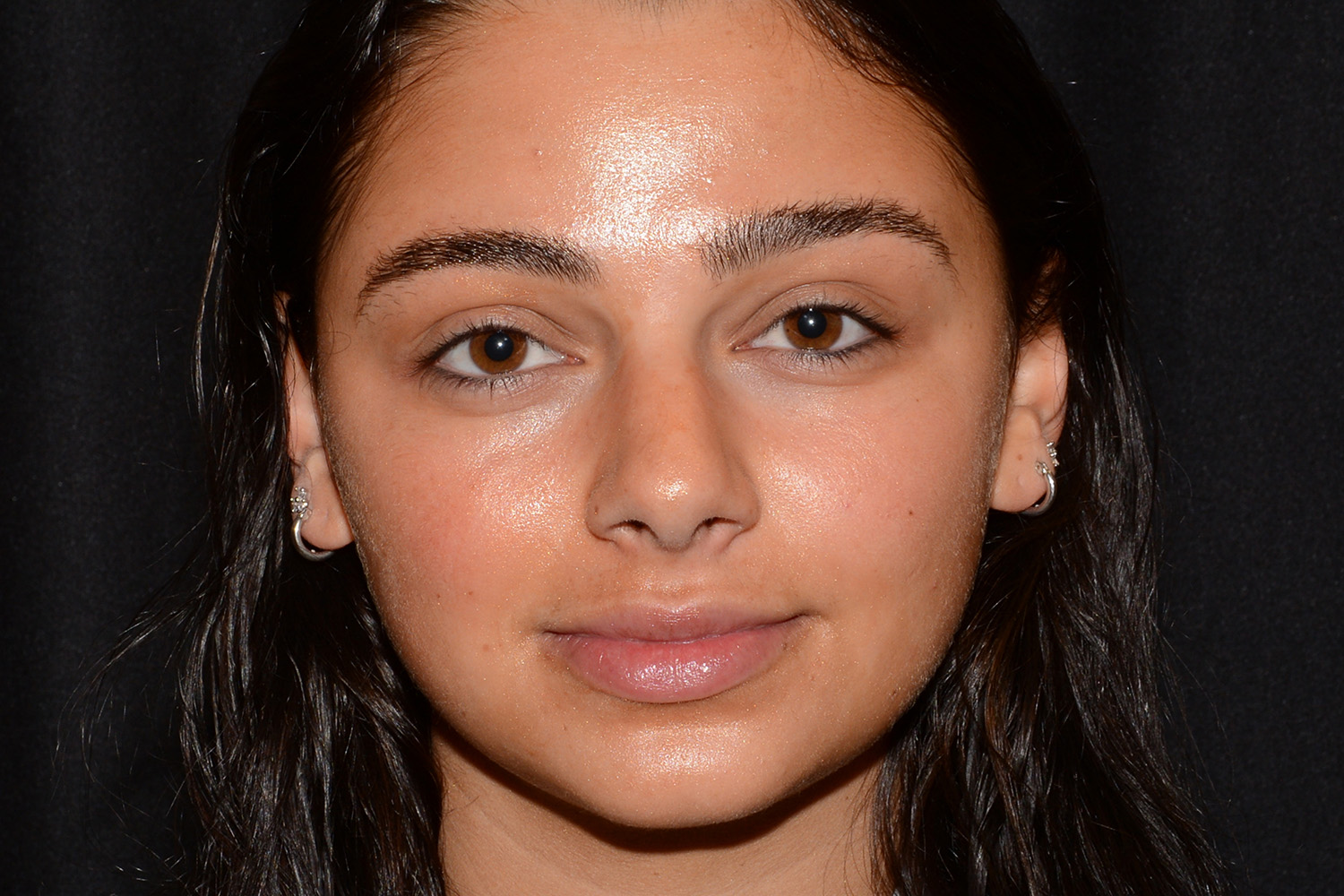 After Image: Lip Filler - front