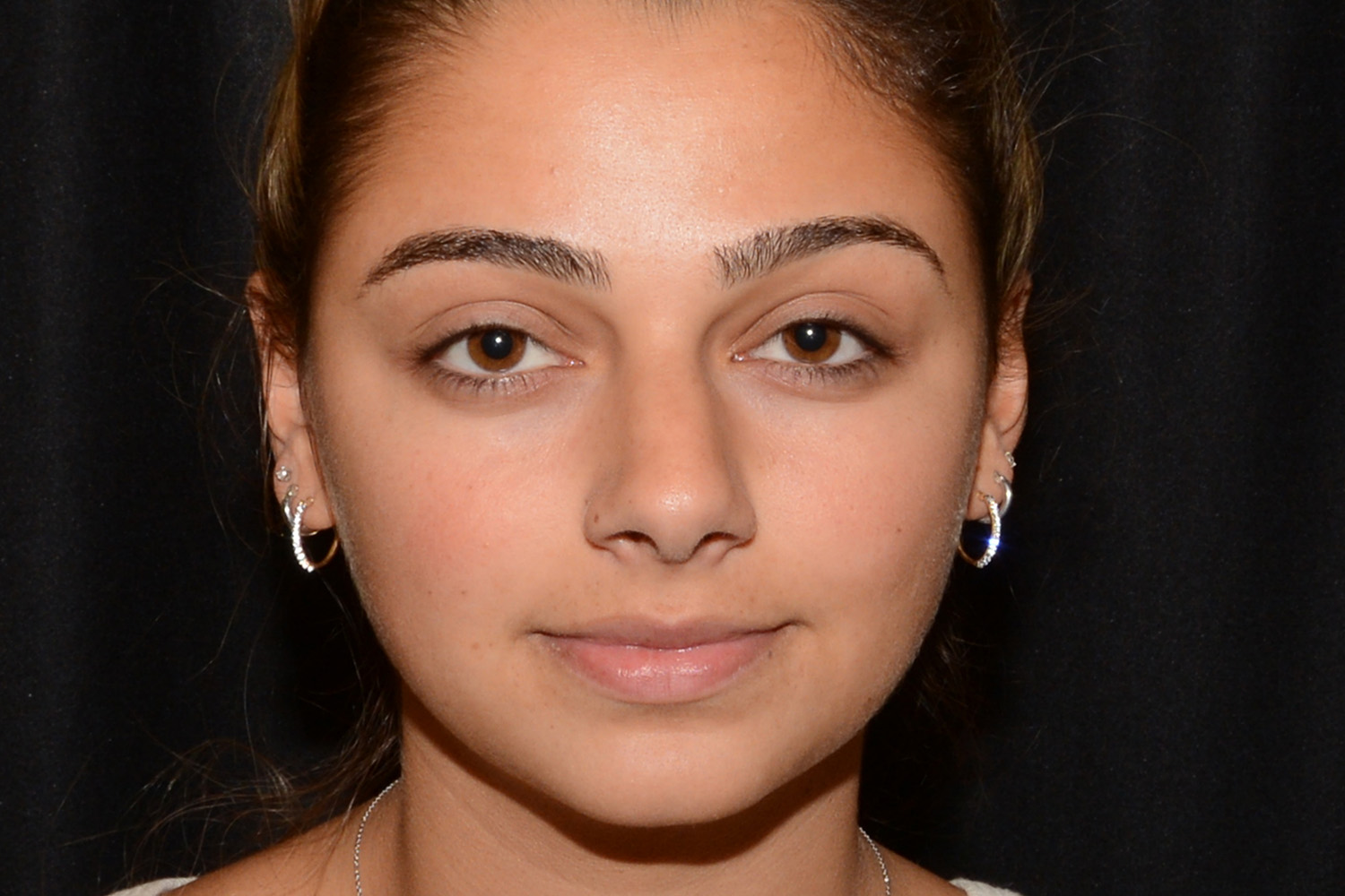 Before Image: Lip Filler - front