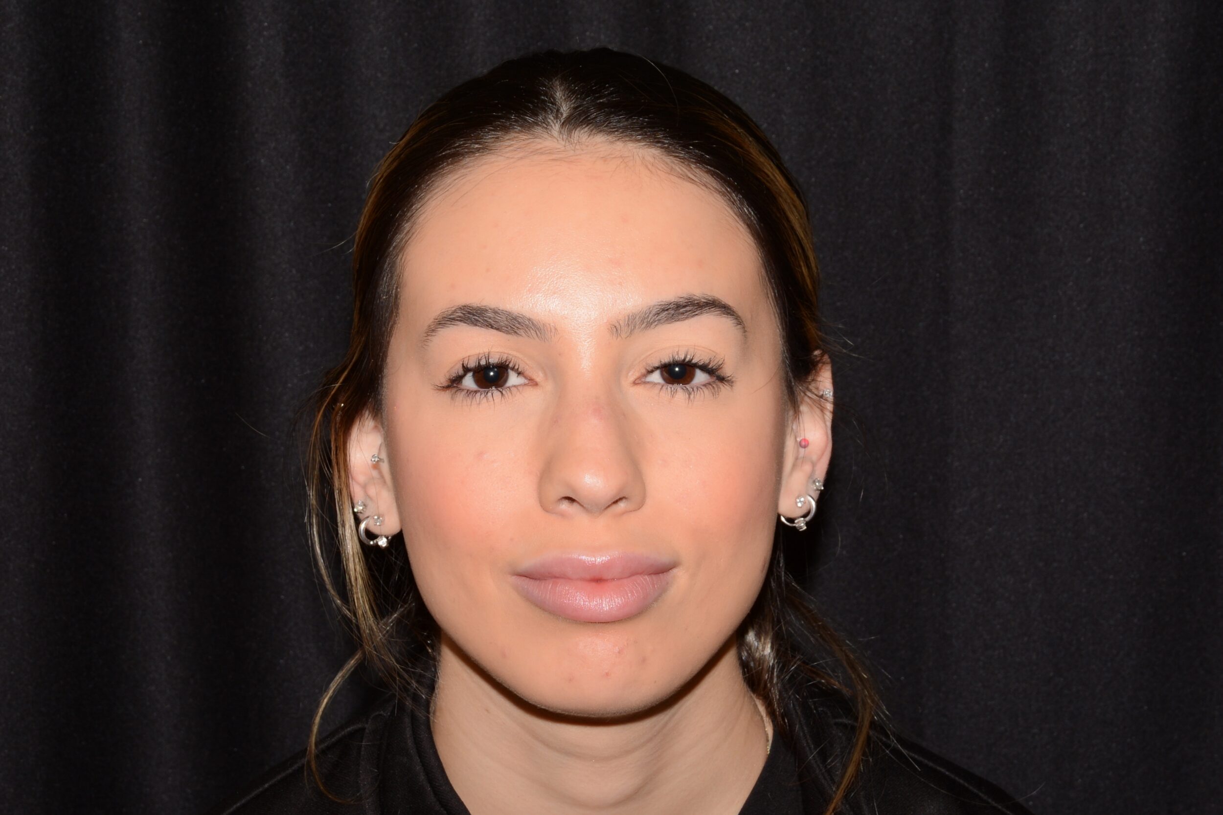 After Image: Lip Filler - front