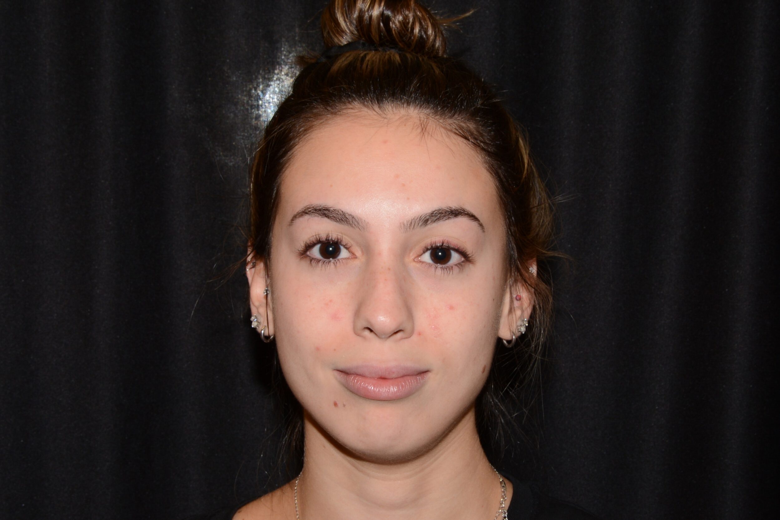 Before Image: Lip Filler - front