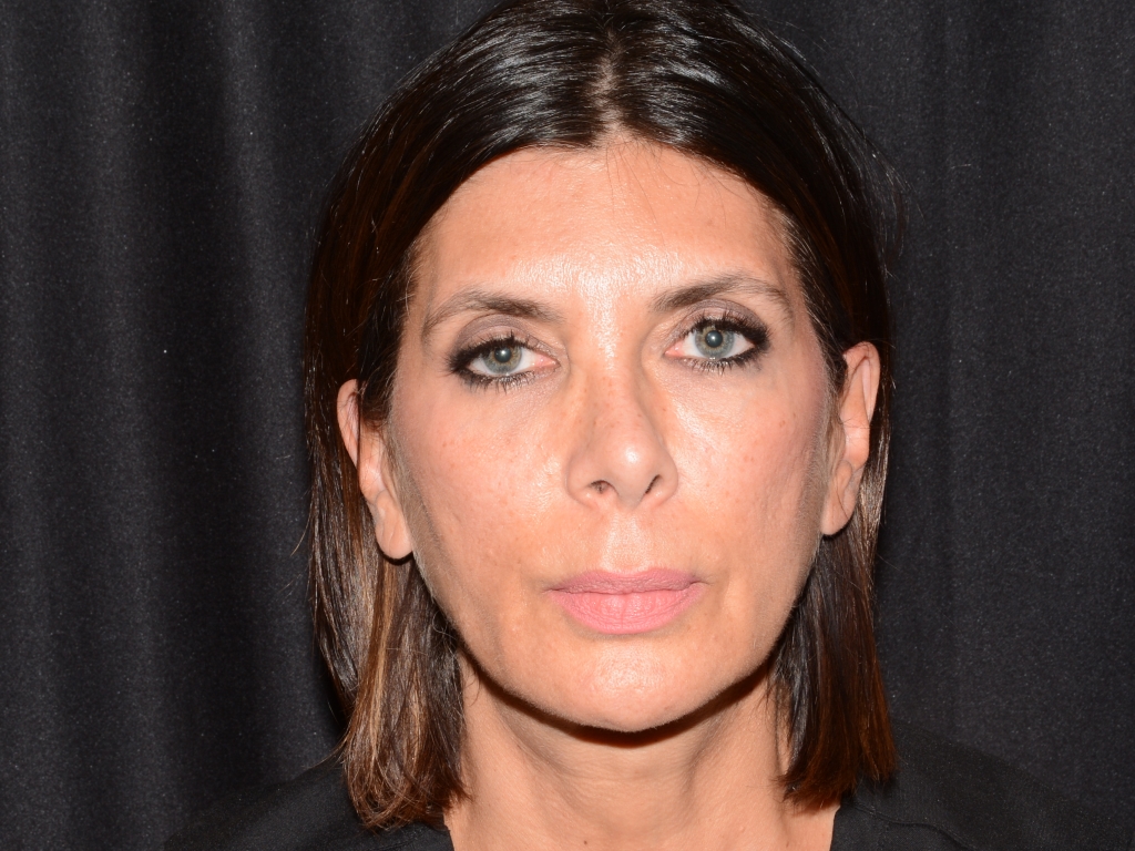 After Image: Sculptra - front