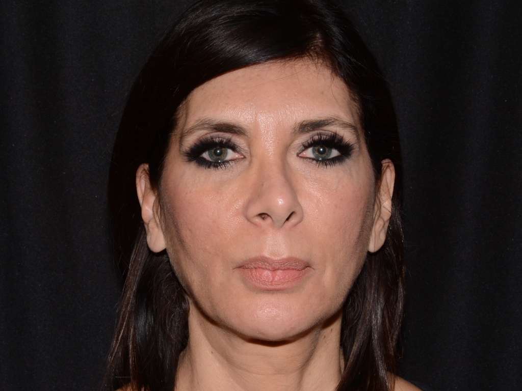 Before Image: Sculptra - front