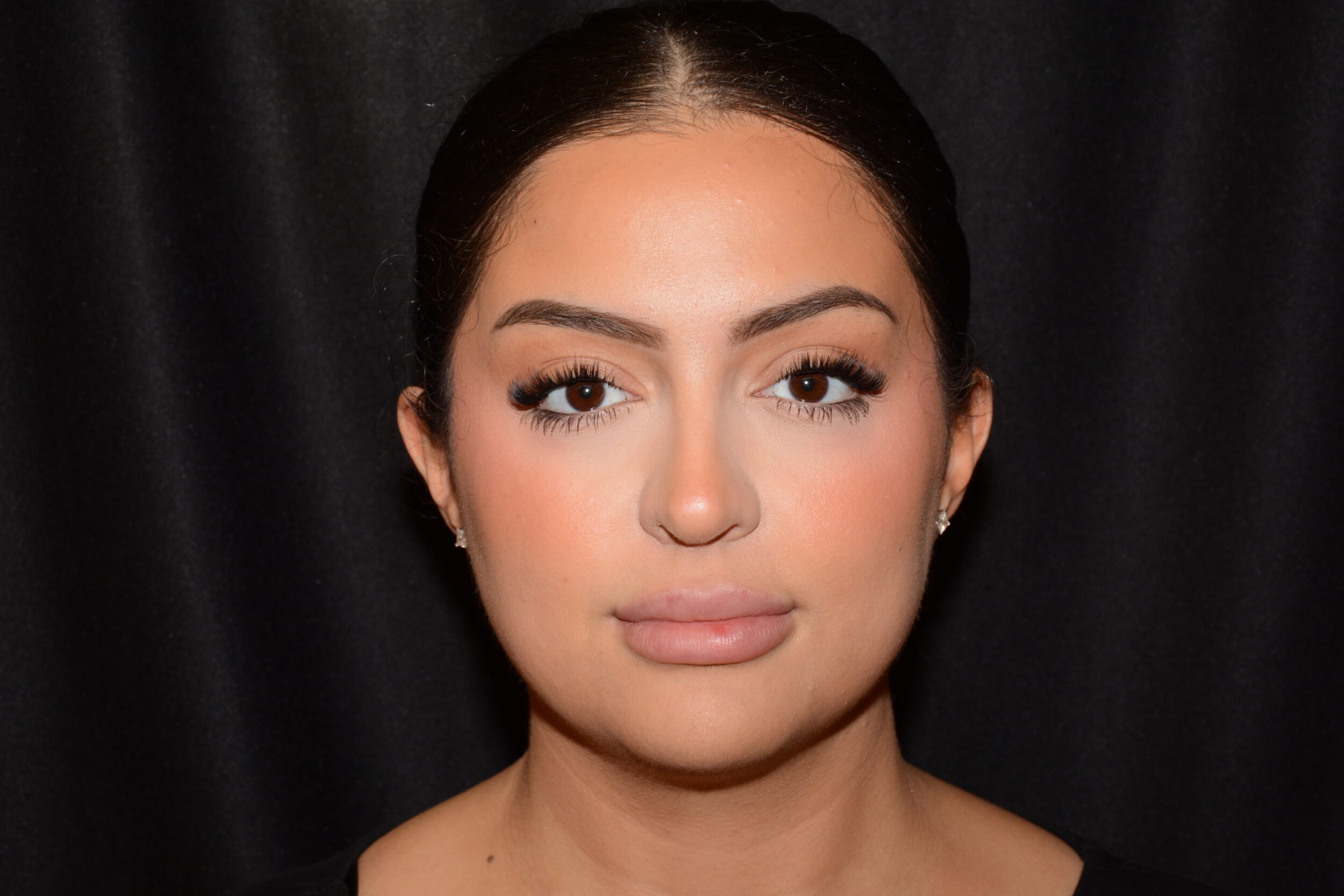 After Image: Lip Filler - front