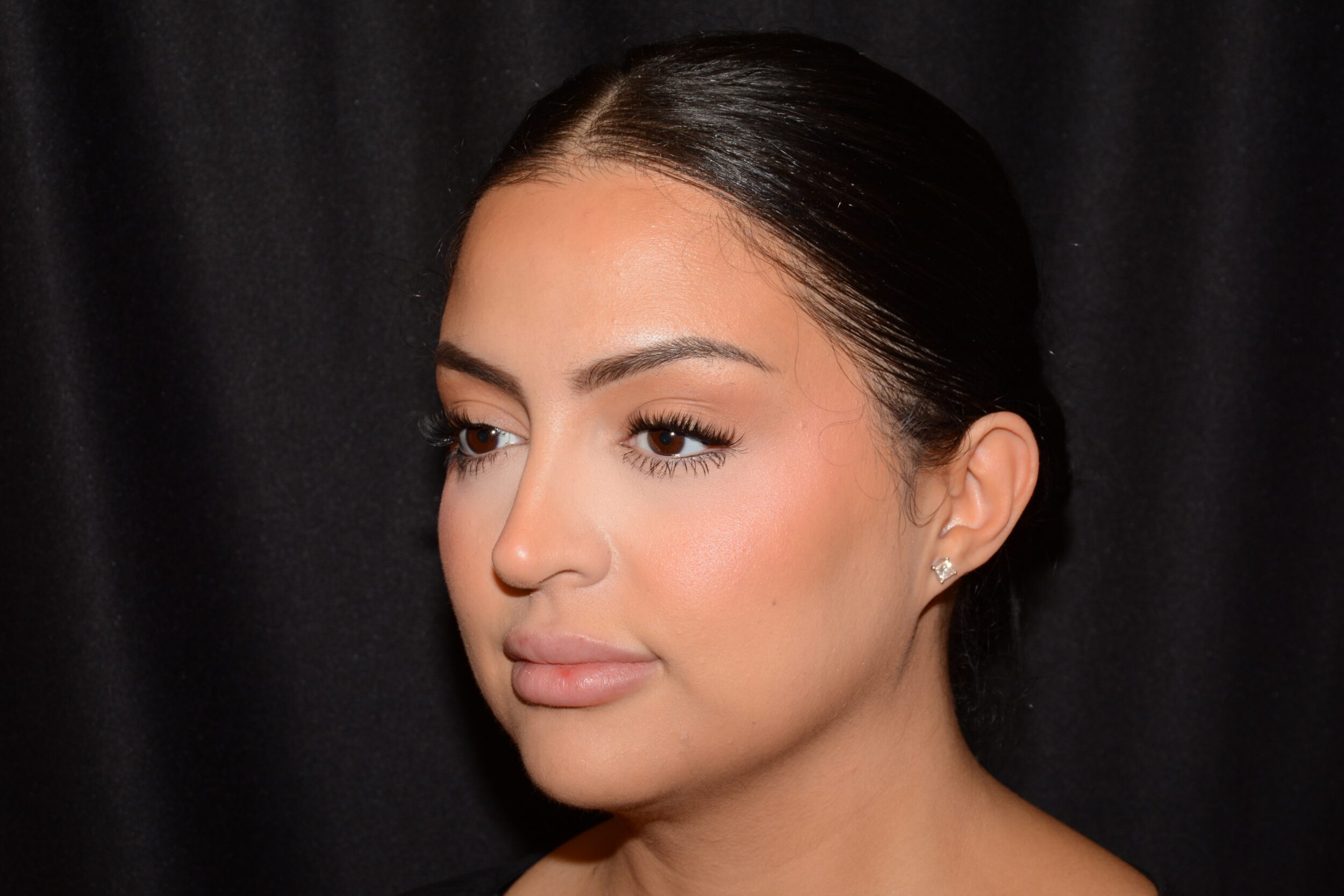 After Image: Lip Filler - left-front-oblique