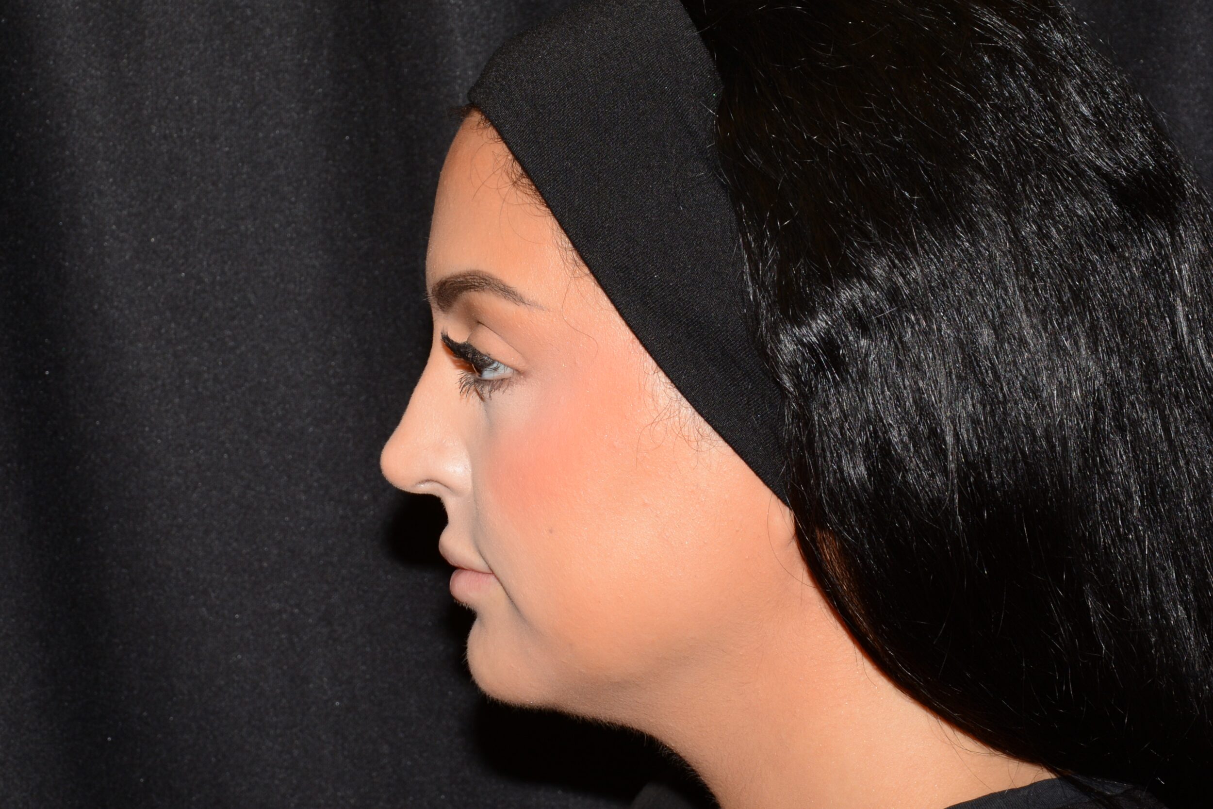 Before Image: Lip Filler - left-side