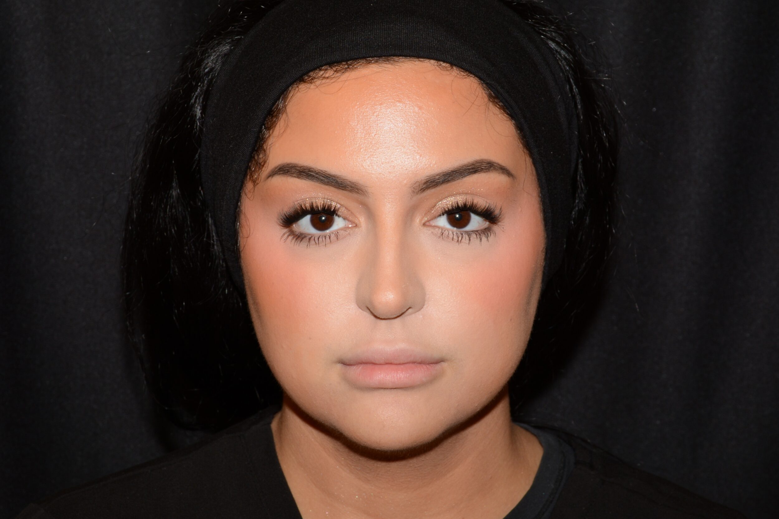 Before Image: Lip Filler - front