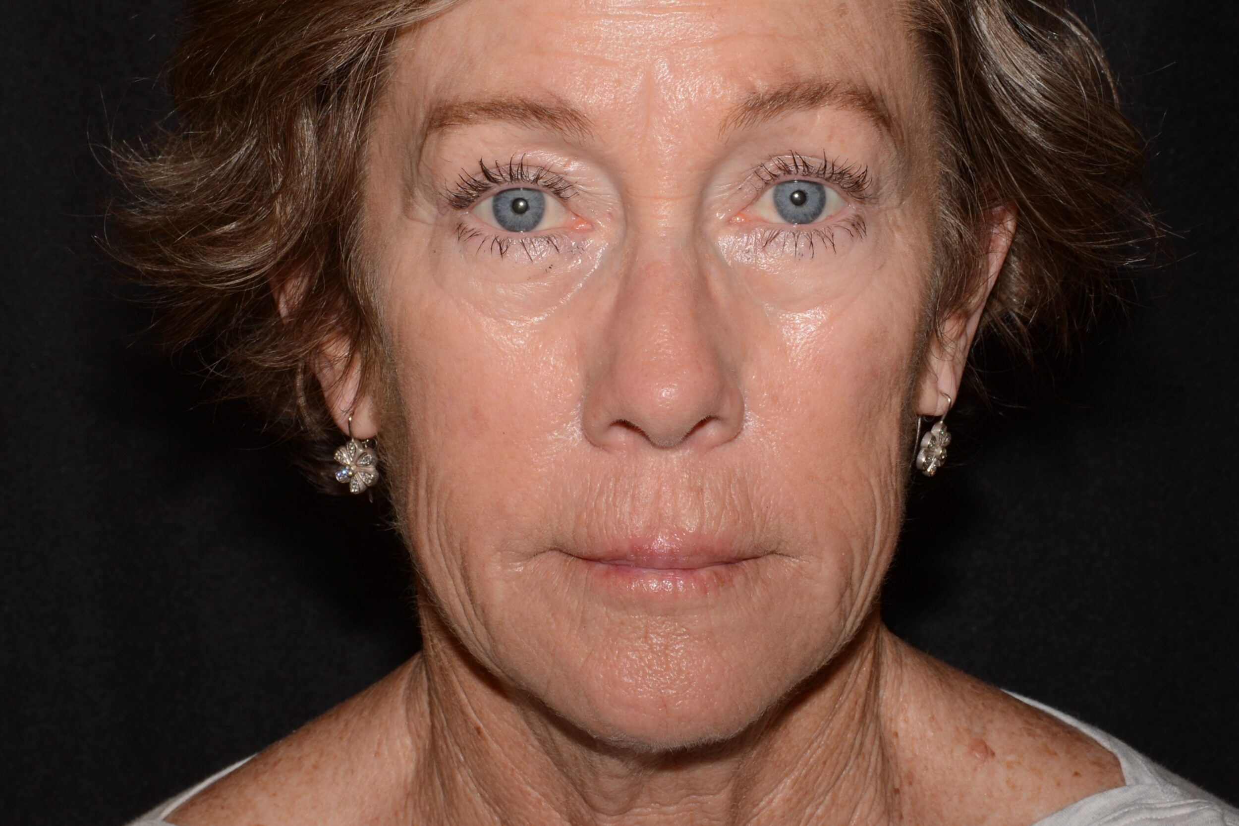 Before Image: Lip Filler - front