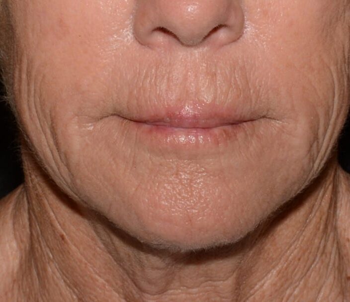 After Image: Lip Filler - front