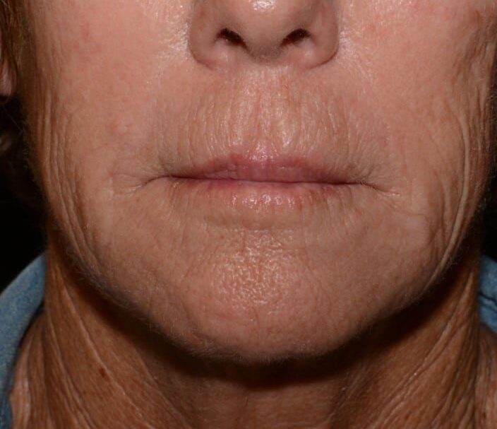 Before Image: Lip Filler - front