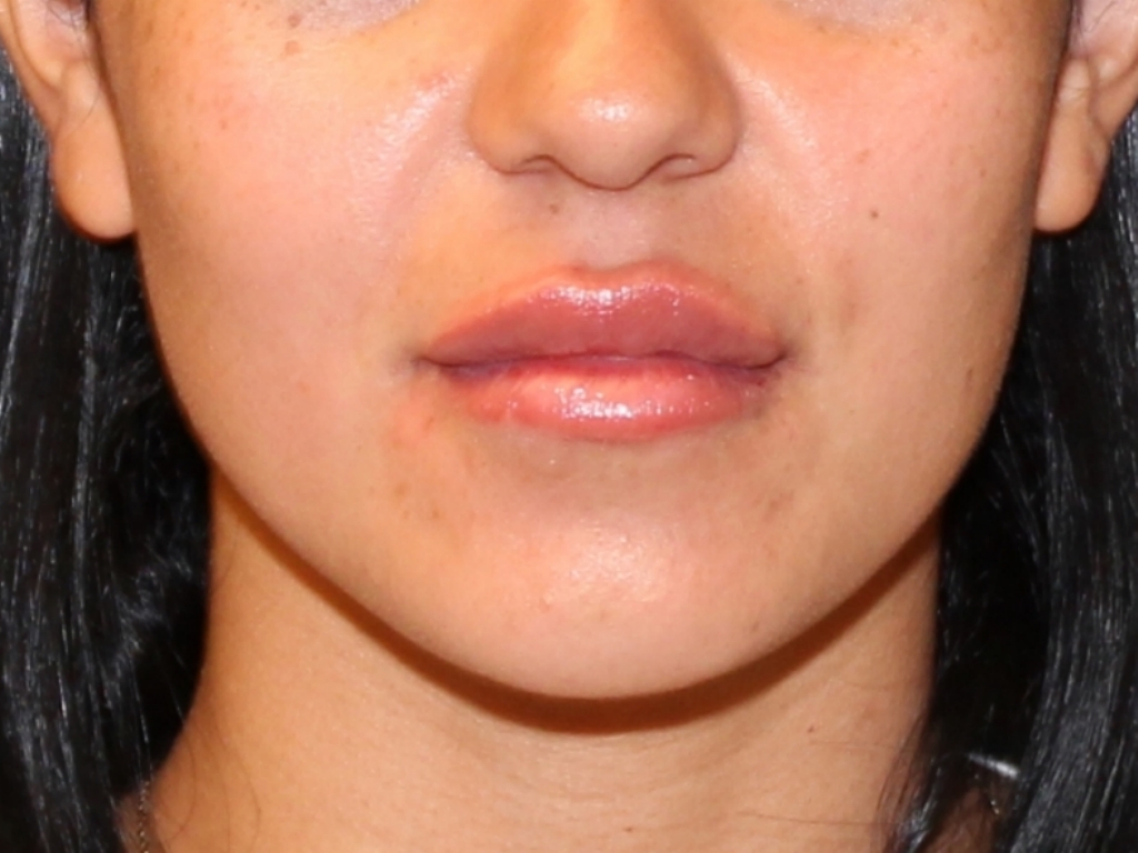 After Image: Lip Filler - front