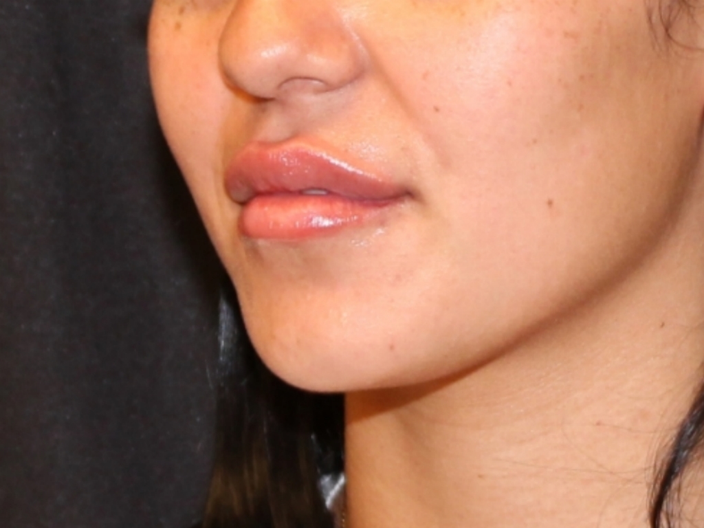 After Image: Lip Filler - left-front-oblique