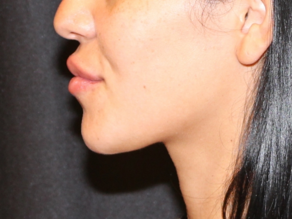 After Image: Lip Filler - left-side