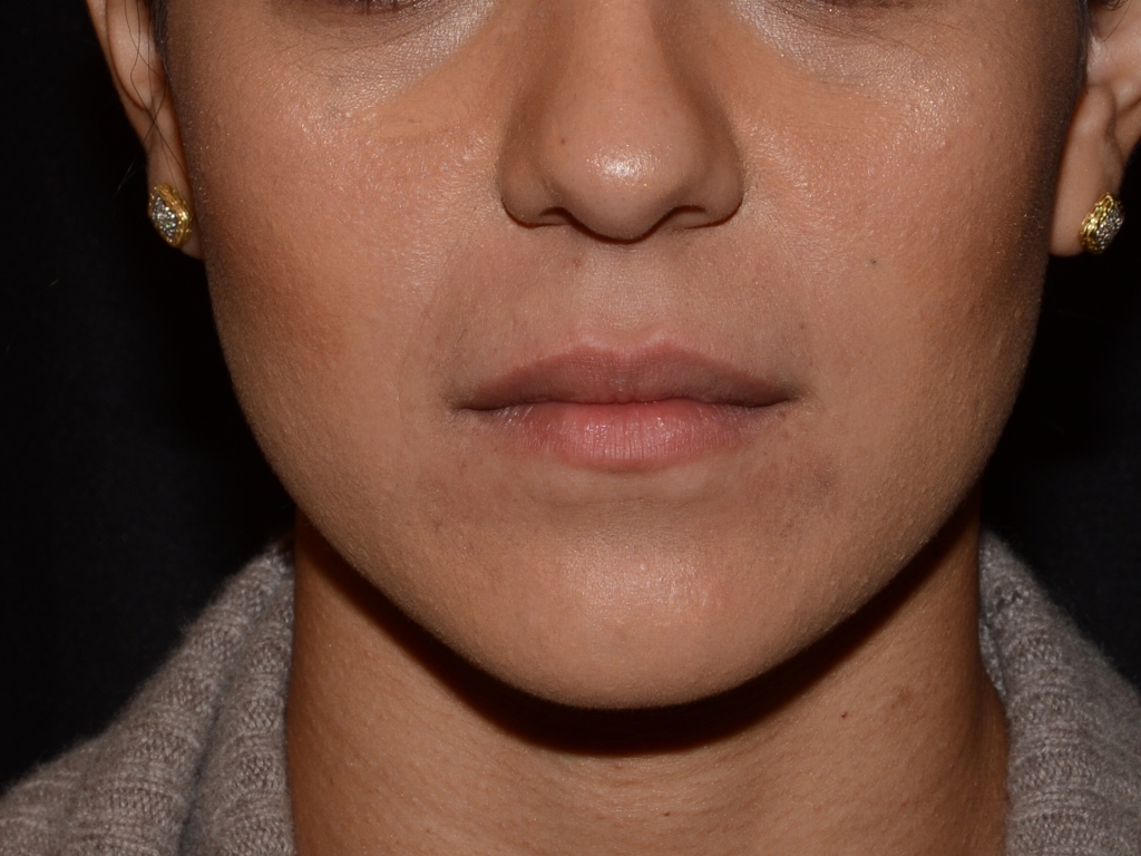 Before Image: Lip Filler - front